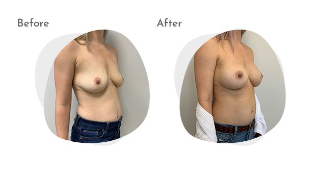 What To Do With Old Silicone Gel Breast Implants Columbus OH
