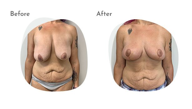 Breast Lift Columbus Ohio  Stratus Plastic Surgery in Columbus