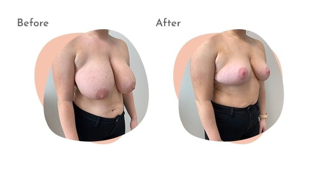 Breast Reduction Columbus Ohio  Stratus Plastic Surgery in Columbus