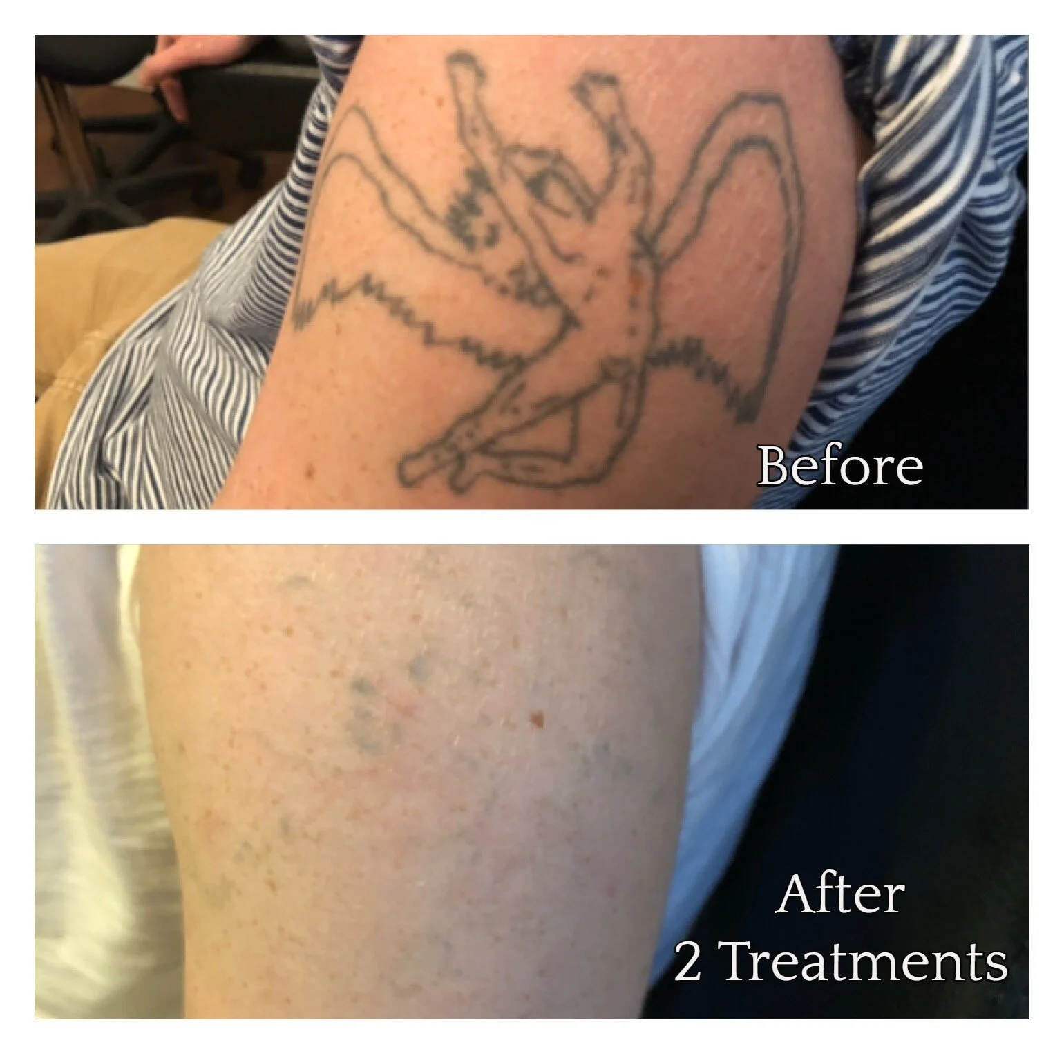 Before & After Disappearing Ink Laser Tattoo Removal — Disappearing Ink
