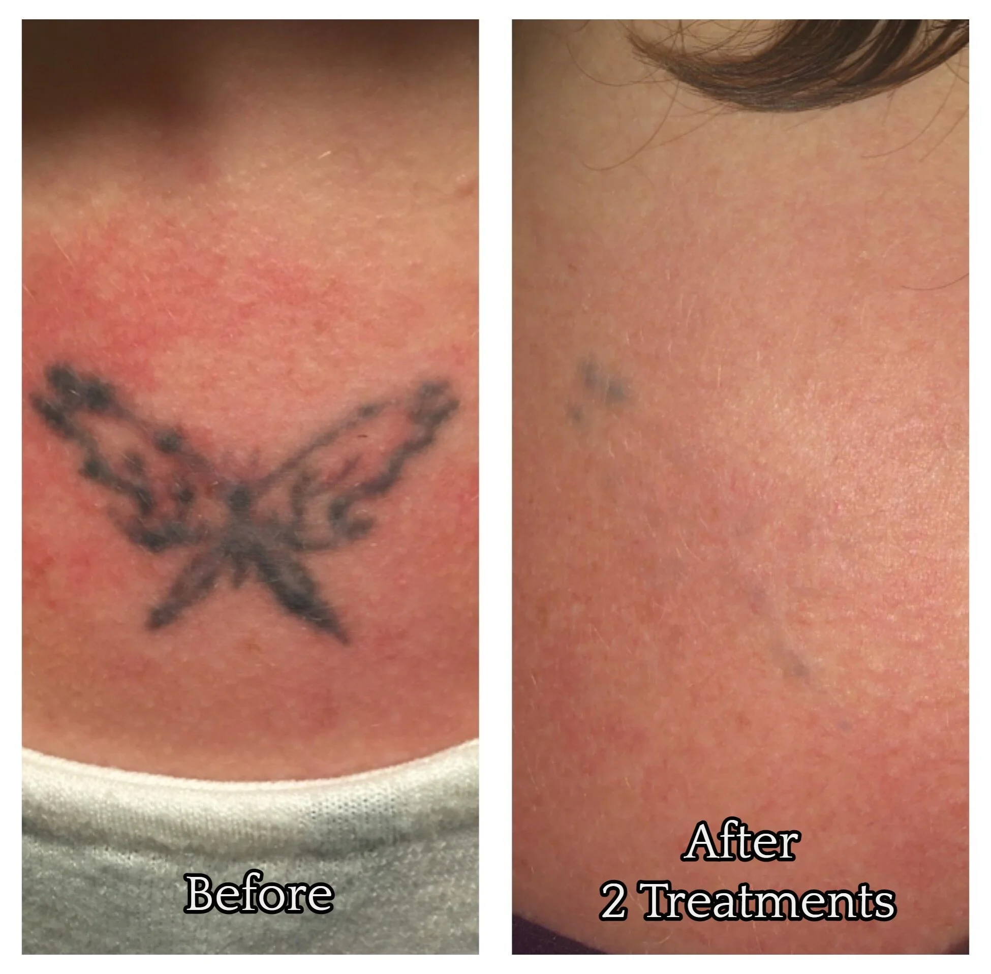 Before & After Disappearing Ink Laser Tattoo Removal — Disappearing Ink