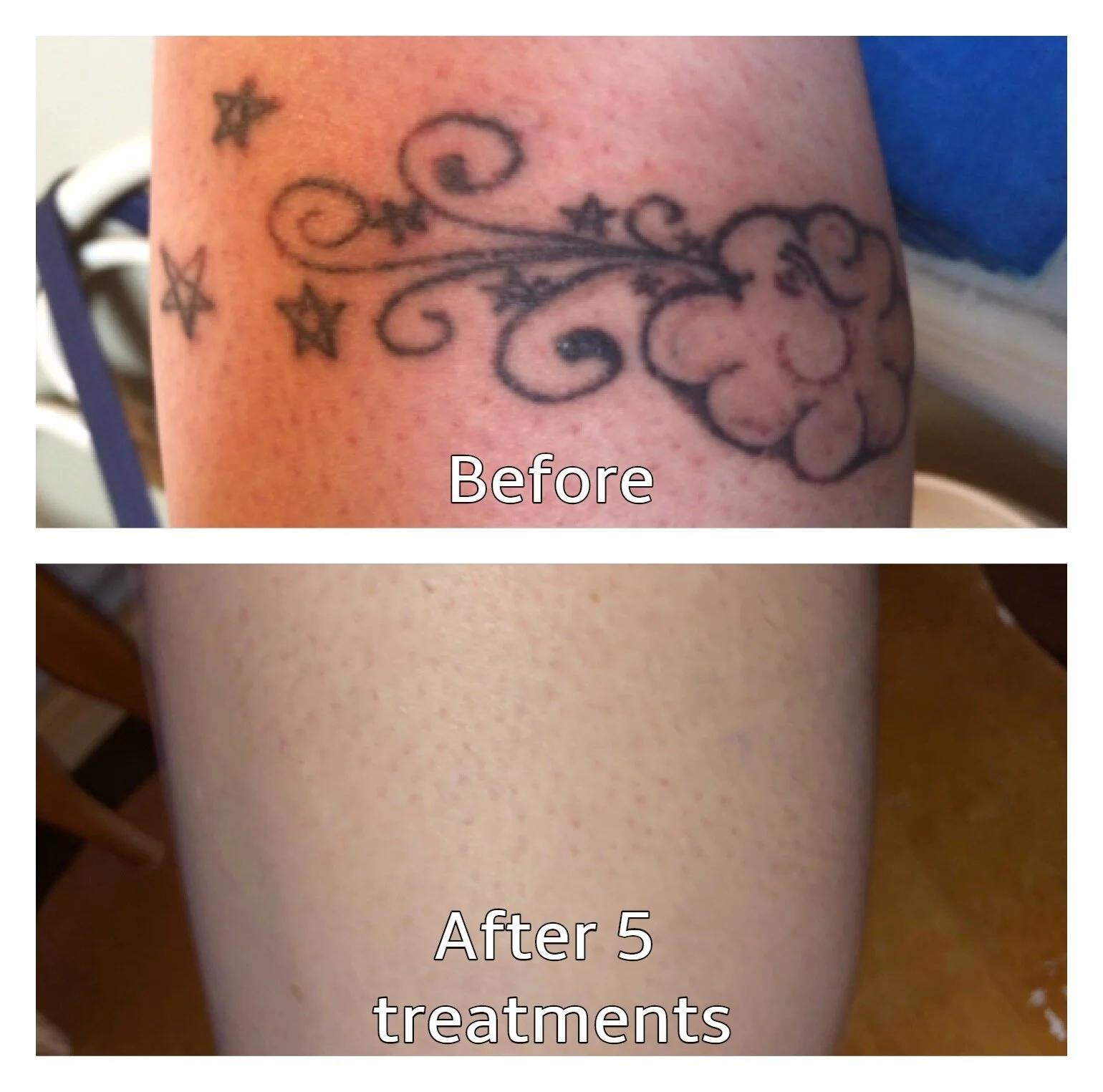 Before & After Disappearing Ink Laser Tattoo Removal — Disappearing Ink