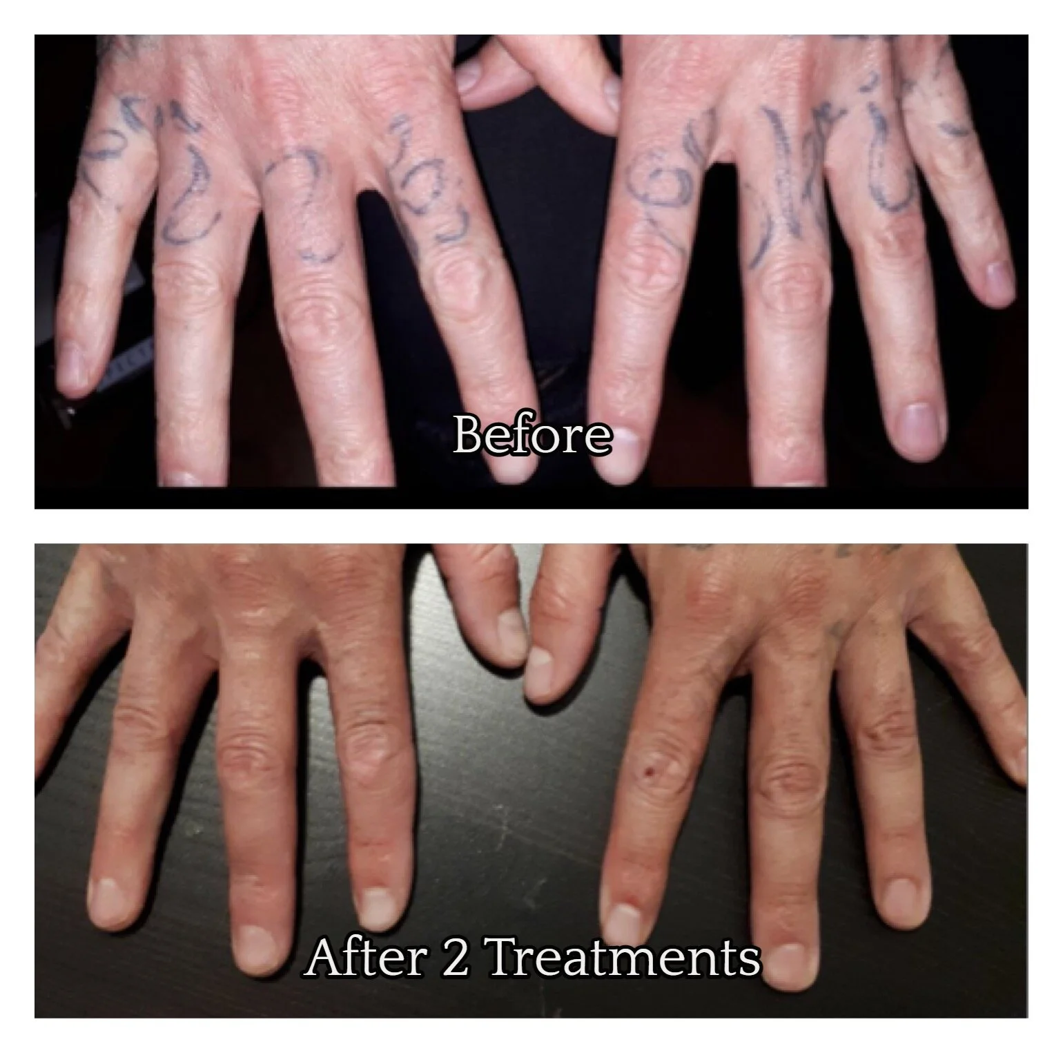 Before & After Disappearing Ink Laser Tattoo Removal — Disappearing Ink