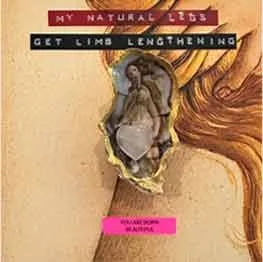 My Natural Legs (Get Limb Lenghthening)