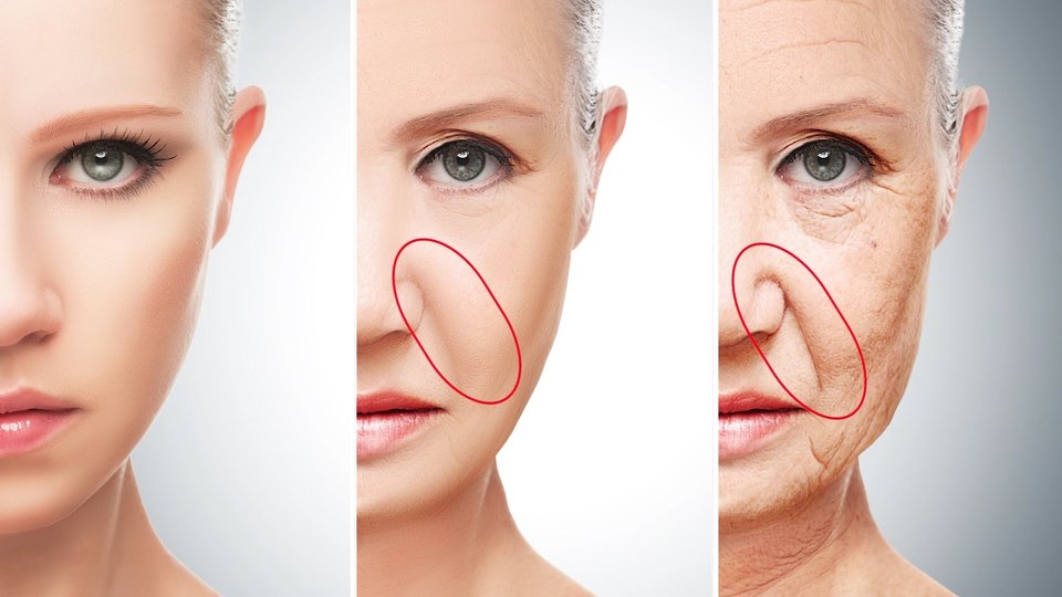 Smooth Away Laugh Lines With Nasolabial Fillers Neurostrive Hydration And Medspa