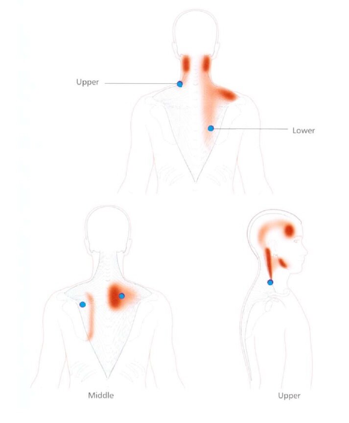 How to Get a Trapezius Knot Release