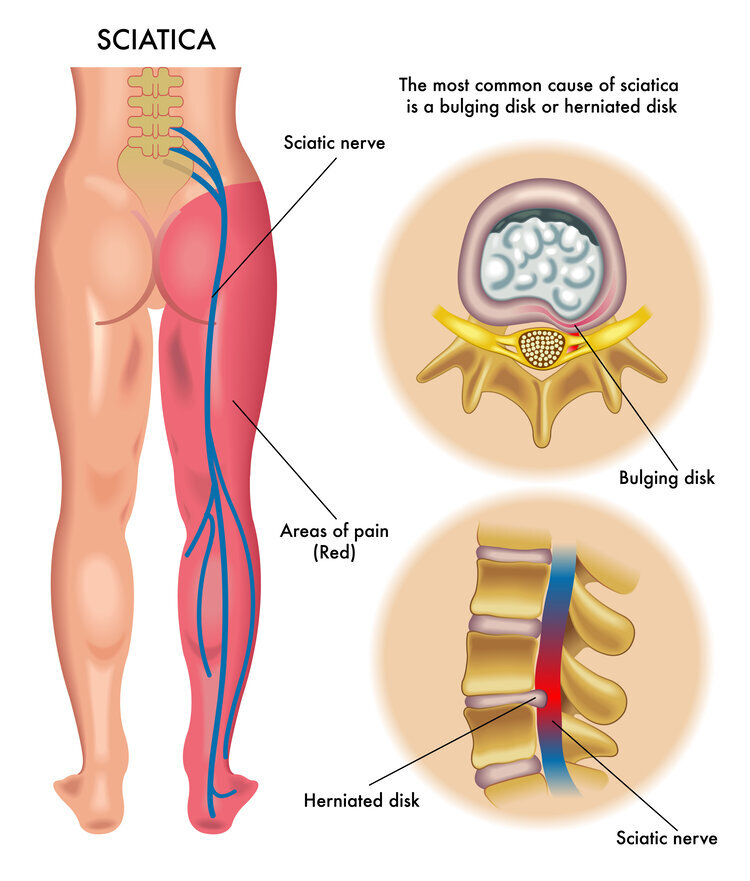 Where Is the Pressure Point for Sciatica?