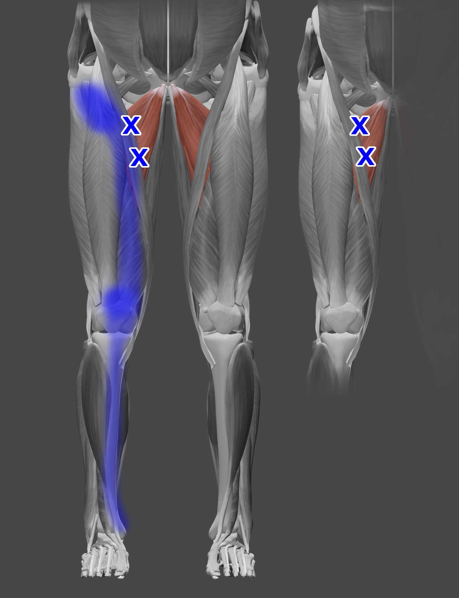 Adductor longus muscle trigger points