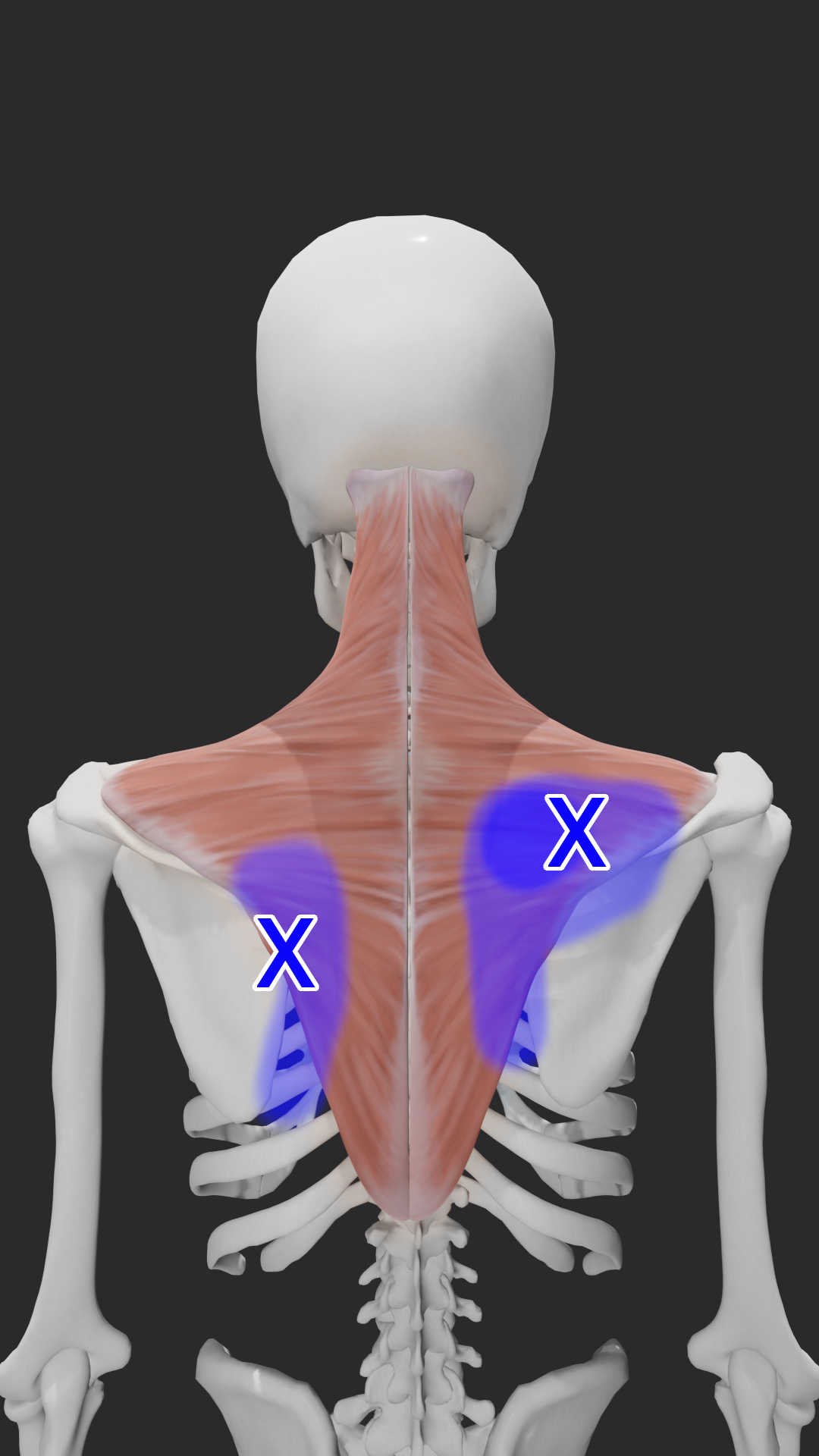 Middle trapezius trigger points