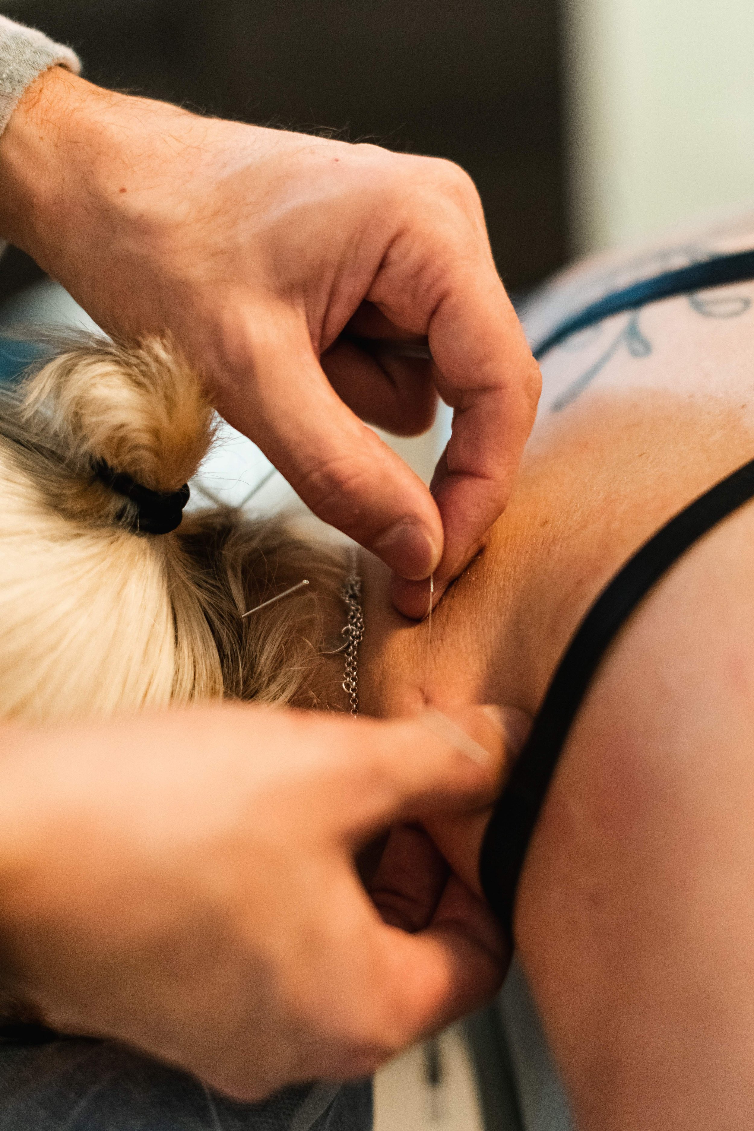 Acupuncture for Trapezius Trigger Points — Morningside Acupuncture NYC