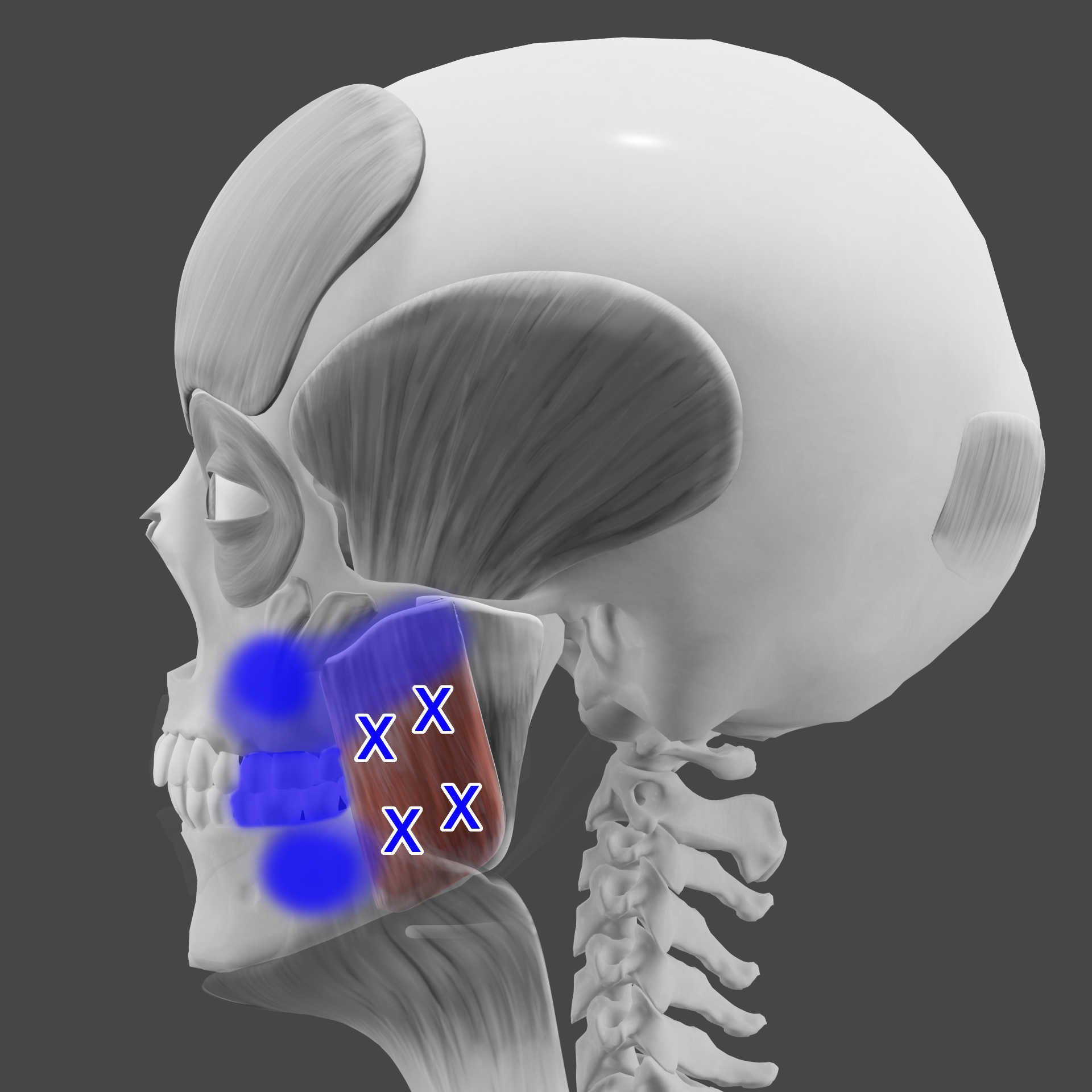 Superficial masseter TrPs