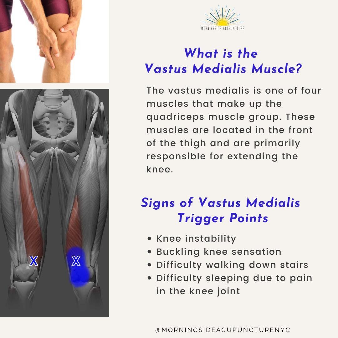 Your vastus medialis muscle, part of your quads, is key for knee stability. When it's weak, you may face knee pain, difficulty with stairs, and sleep disruption. Causes can be foot structure or activities like jogging or skiing. Luckily, acupuncture 