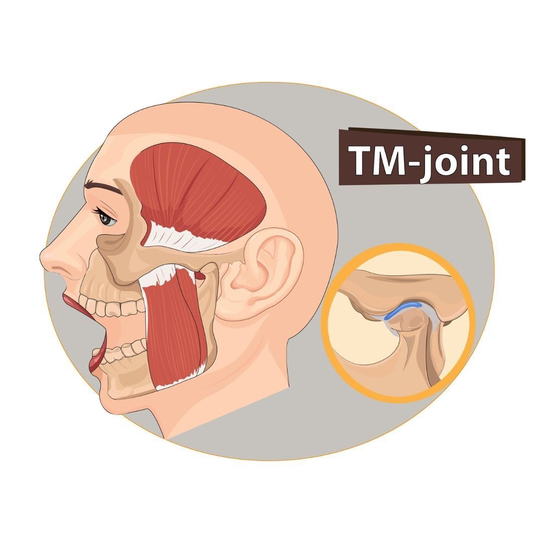 The Temporomandibular Joint (TMJ) is a complex structure that facilitates jaw movement. It connects the jawbone to the skull, enabling you to talk, chew, and yawn. TMJ disorders cause significant jaw pain and discomfort that can severely impact the q