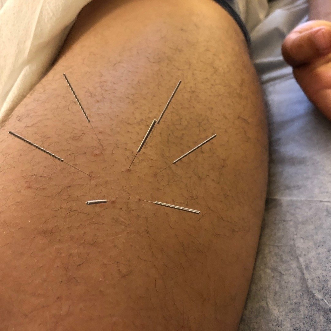 Acupuncture treatment to relieve pain from a hamstring strain. 🦵🏼⁠
⁠
⁠
⁠
#AcupunctureWorks #PainRelief #FascialRelease #NYCAcupuncture #JointPain #NervePain #SportsMedicine #HolisticHealth #washhts #injuryrelief