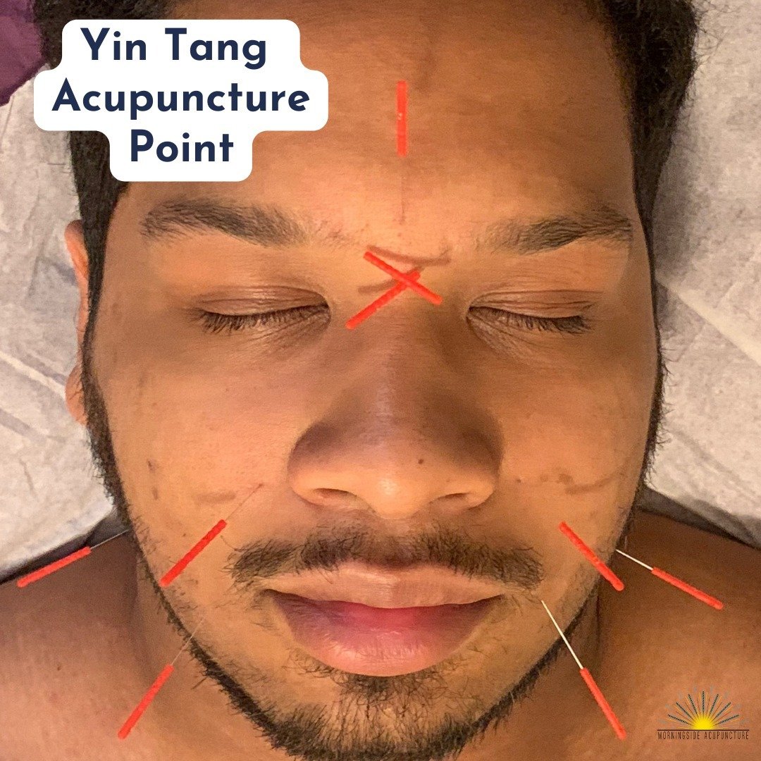 Are you feeling stressed and anxious lately? 😵 Calm your mind with this powerful acupuncture point. Yin Tang, located between the eyebrows, has been used for centuries to ease anxiety, insomnia, and stress. ⁠
⁠
📍Needled gently, it connects to the &