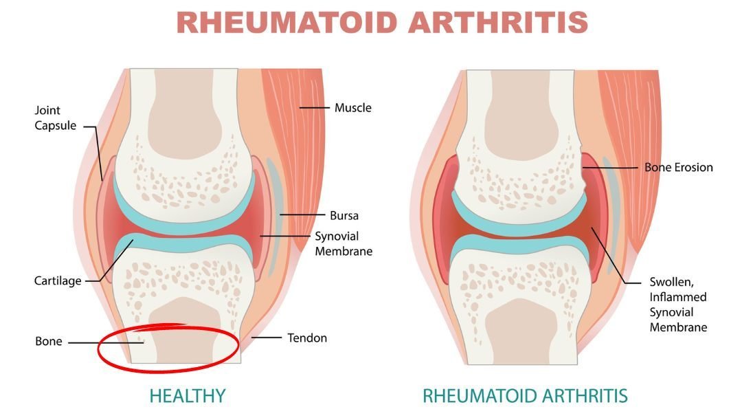 🔹Dealing with rheumatoid arthritis is a tough battle. Acupuncture is now acknowledged for its potential in supporting RA patients. ⁠
⁠
🔹Beyond joint discomfort, RA is a chronic autoimmune condition causing pain and possible organ damage. ⁠
⁠
🔹Earl
