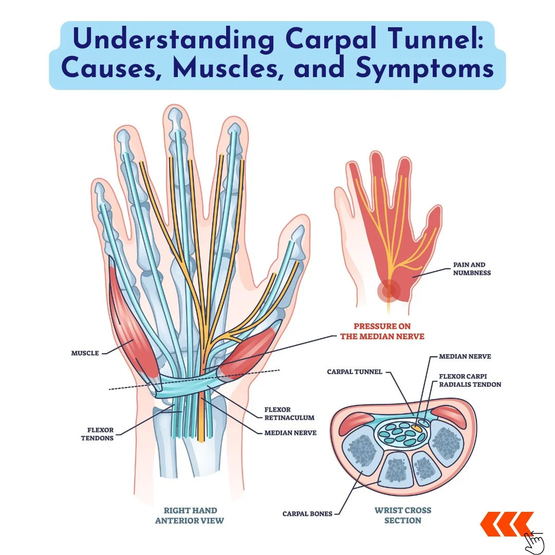 💡Carpal Tunnel Syndrome symptoms can mimic other conditions like pronator teres syndrome or cervical radiculopathy. Traditional treatments often involve NSAIDs, wrist splints, physical therapy, or, in severe cases, surgery. However, an integrated ap