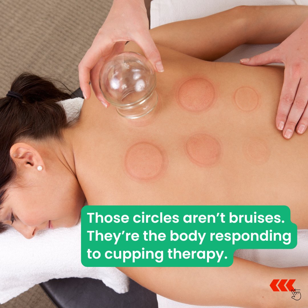 Those circles aren&rsquo;t bruises 👀⁠ They&rsquo;re your body responding to cupping therapy.⁠
⁠
Cupping uses suction to lift tight tissue, increase circulation, and release stagnation, which helps muscles relax, inflammation calm down, and recovery 