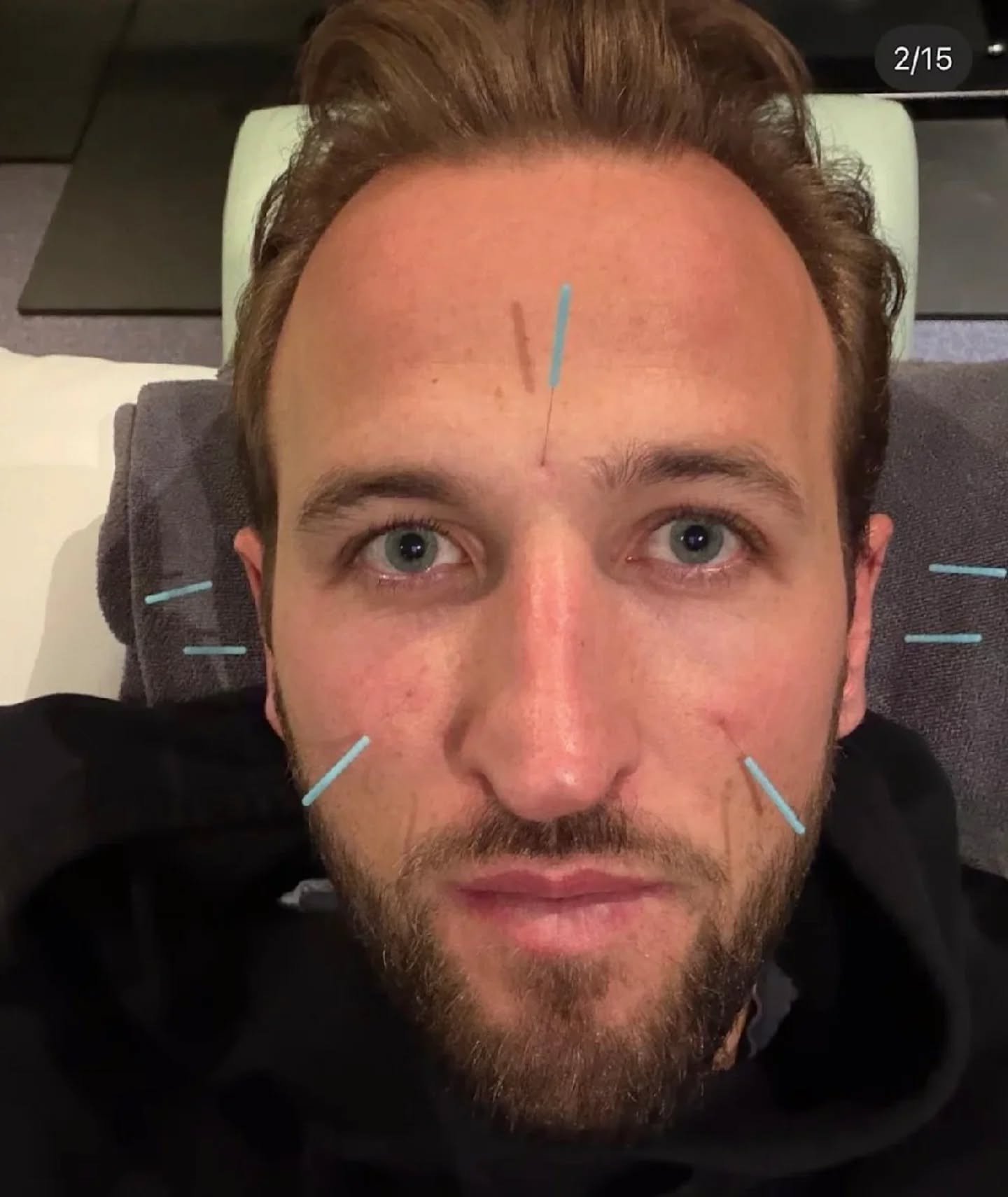 ⚽ FC Bayern Munich's Harry Kane receiving acupuncture.⁠
⁠
Repost from @bayerntimes:⁠
⁠
🚨Harry Kane does not rely solely on FC Bayern's medical staff and fitness coaches; he also consults Spanish sports medicine specialist Alejandro Elorriaga.⁠
⁠
Elo