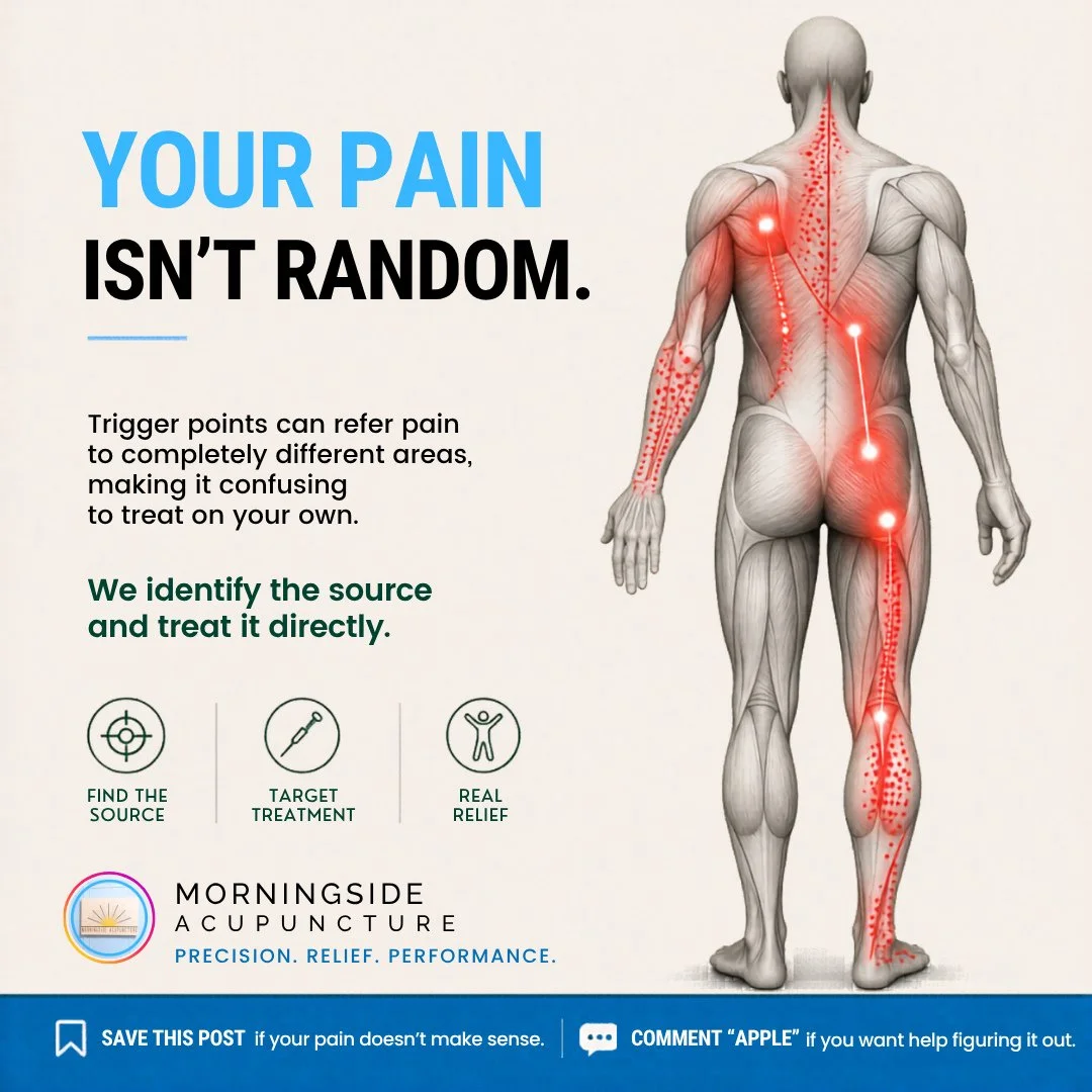 Trigger points refer pain to completely different areas, which is why treating where it hurts often doesn't work. A trigger point in your shoulder blade can feel like a headache.⁠
⁠
At Morningside Acupuncture, we map potential sources before we touch