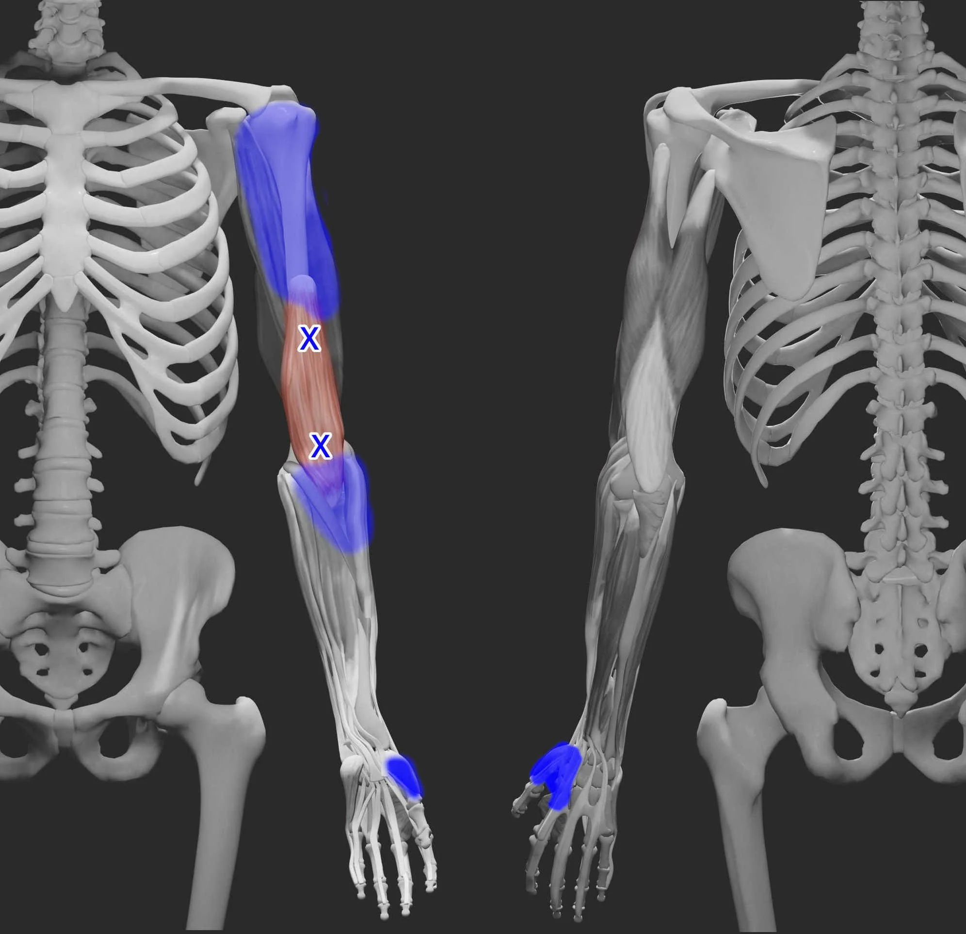 brachialis trigger points