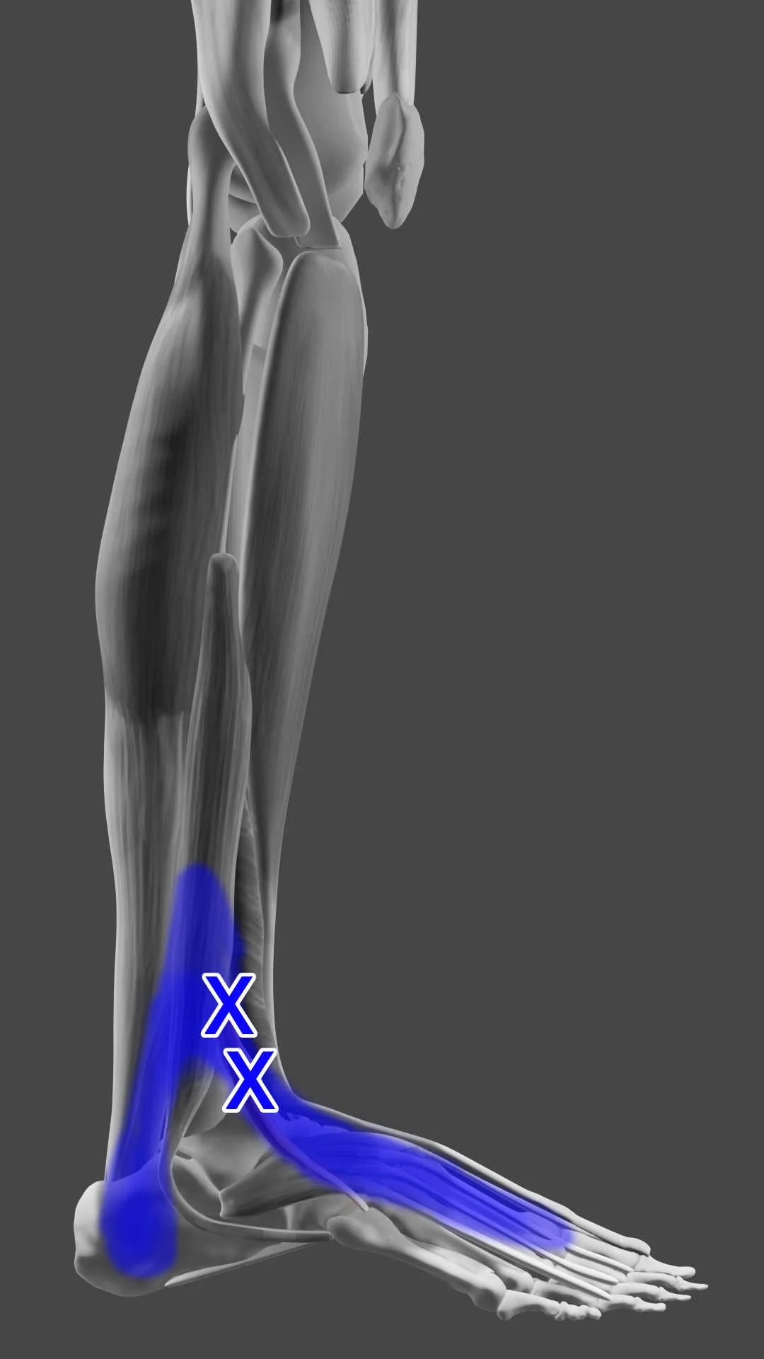 Peroneus tertius trigger points