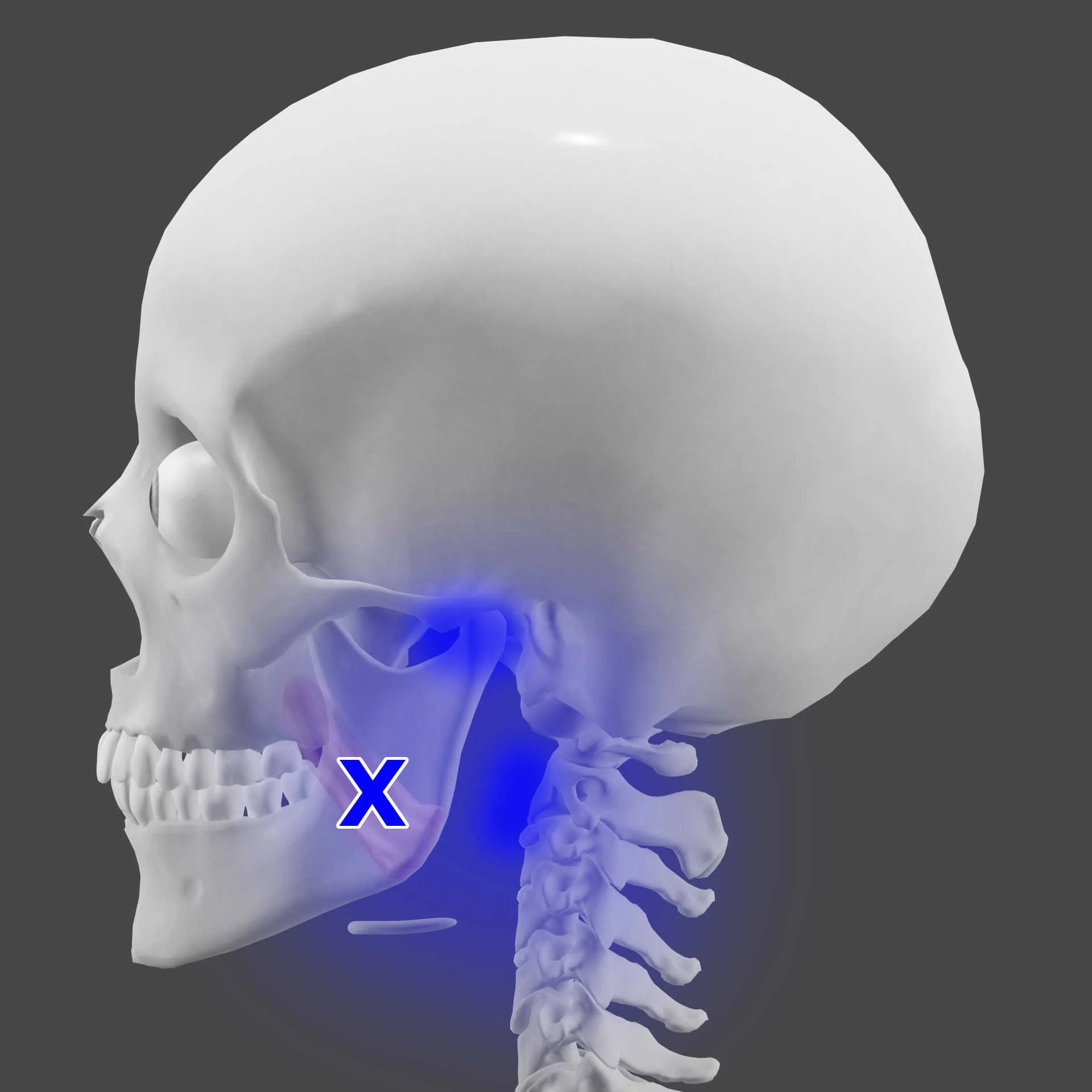 Medial Pterygoid trigger points