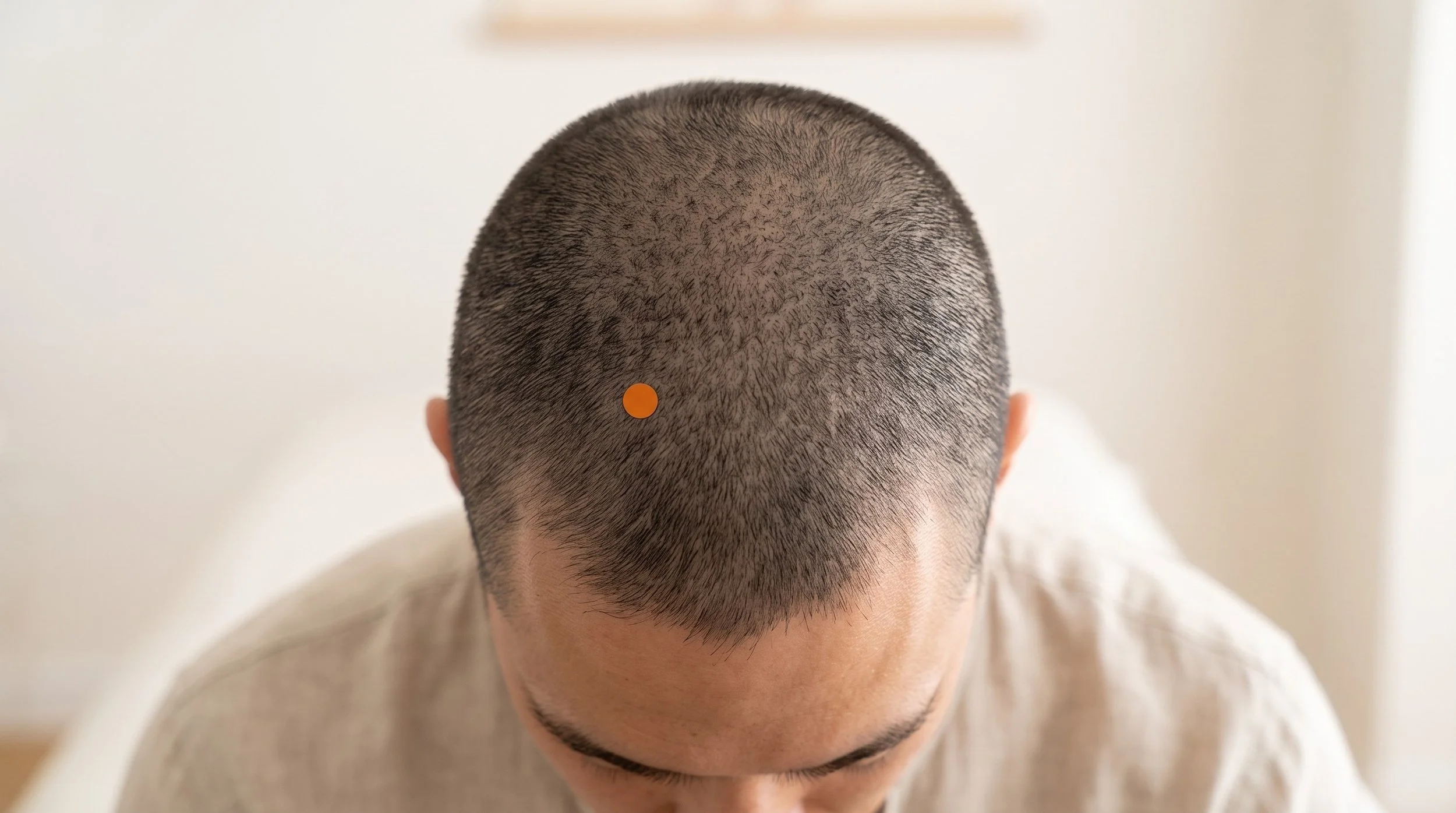 BL6 Acupuncture Point (Chengguang)