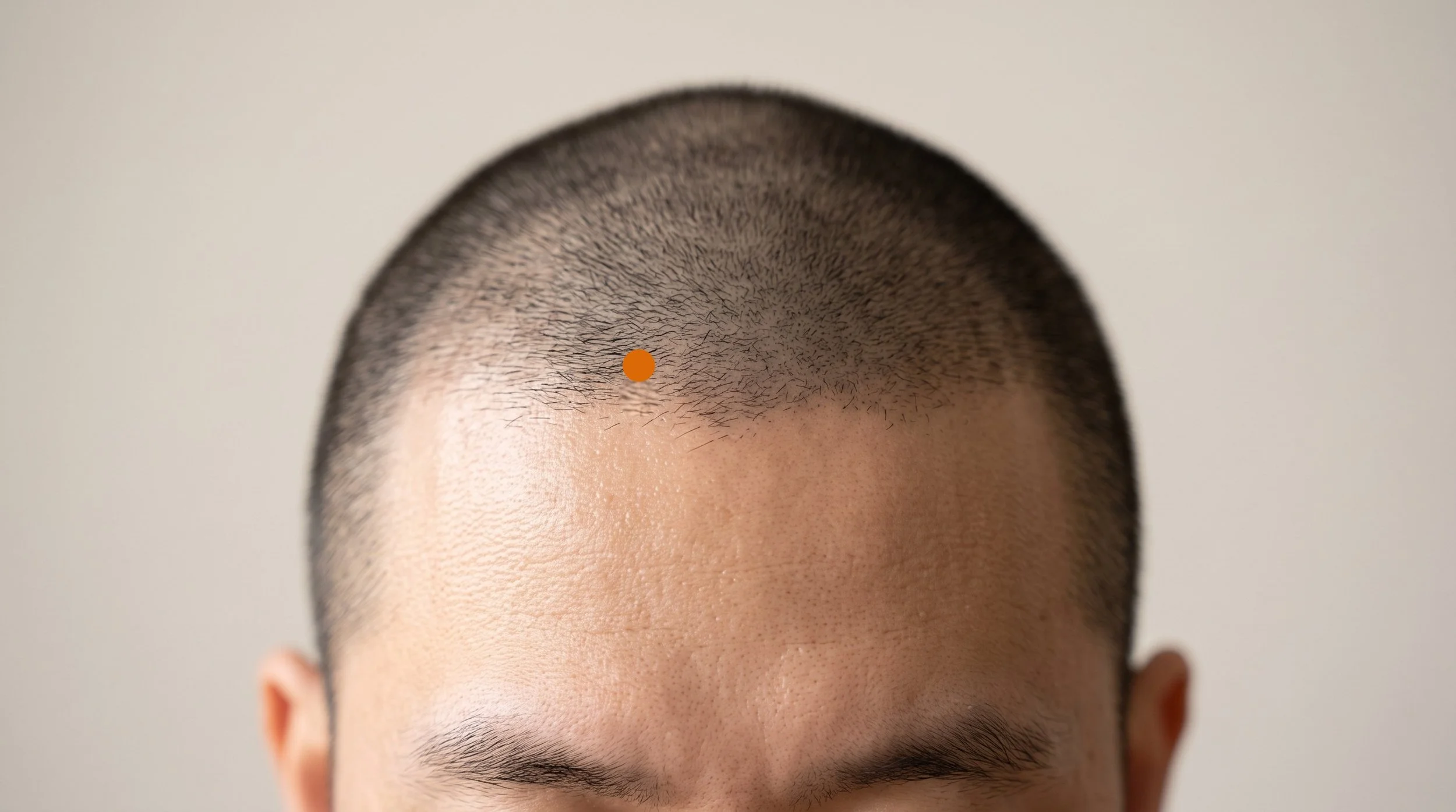 BL3 Acupuncture Point (Meichong)