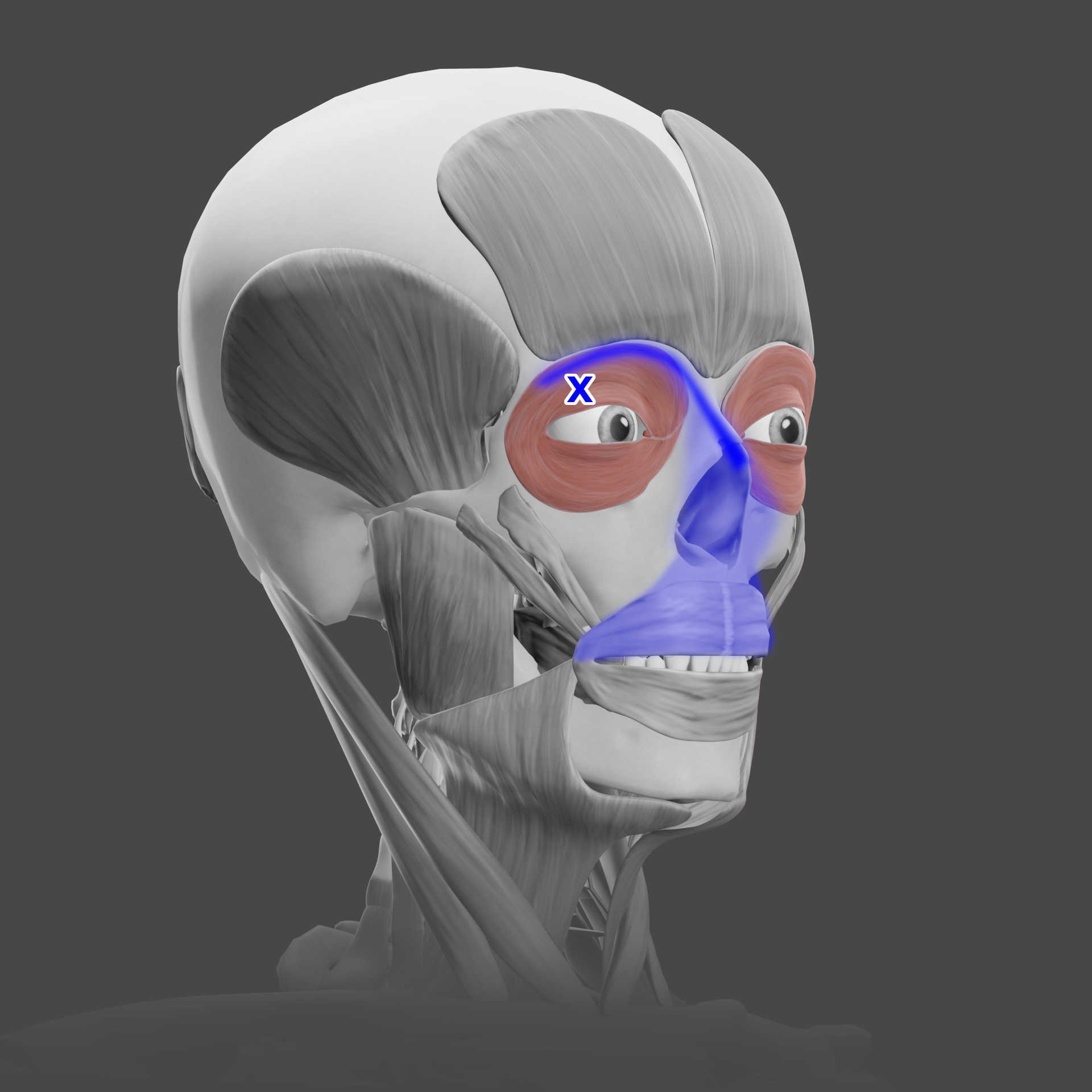 Orbicularis Oculi trigger points