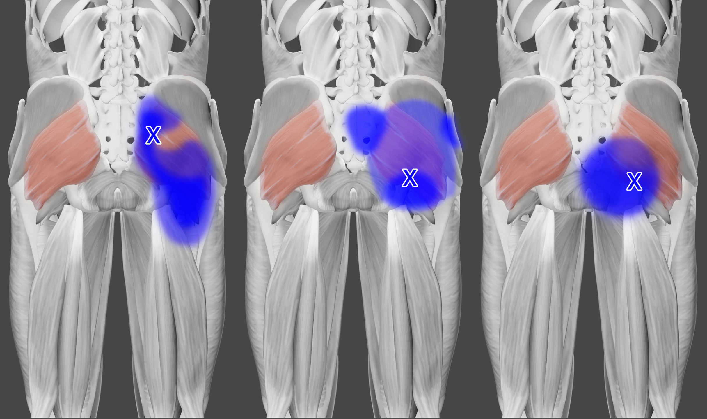 Gluteus maximus trigger points