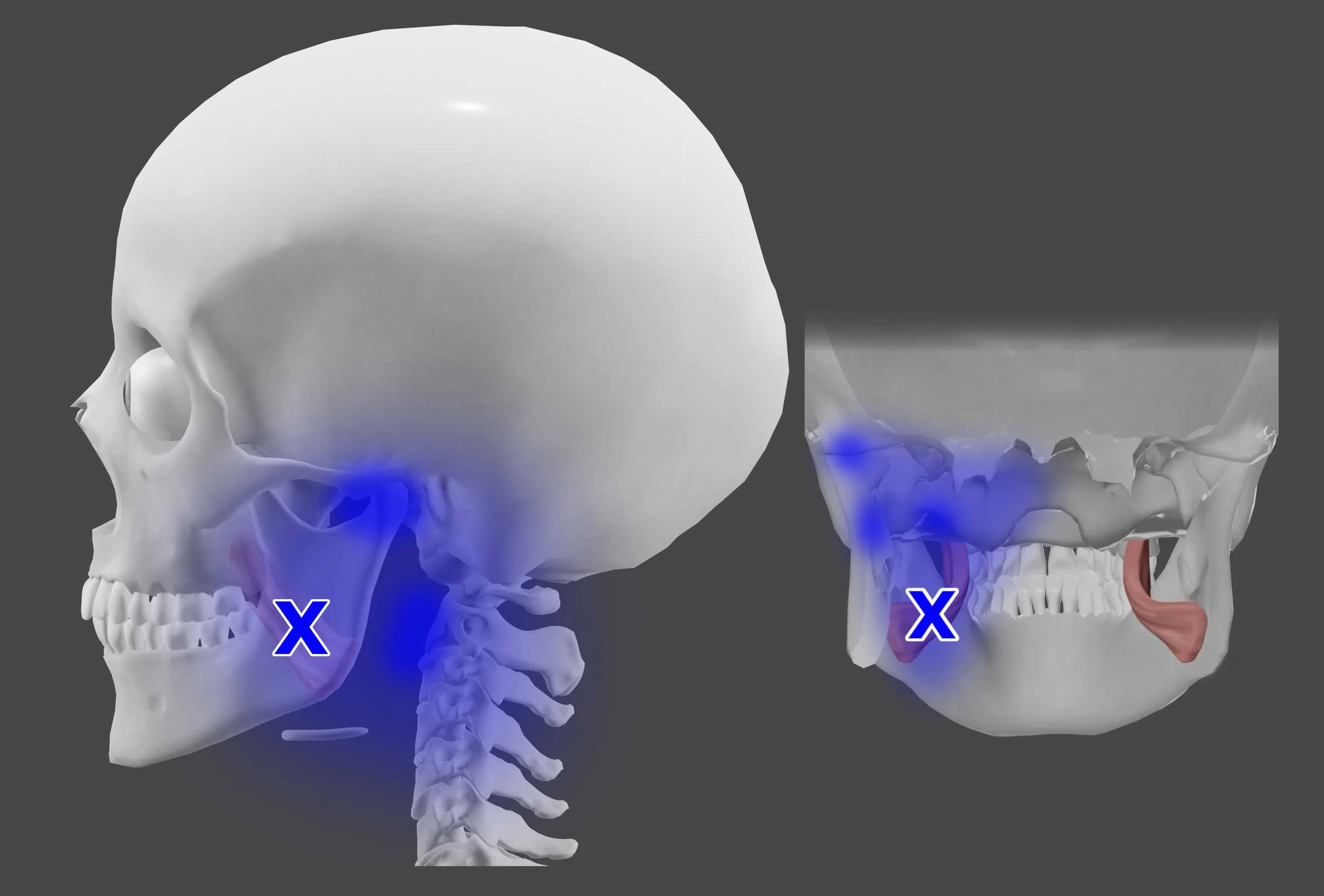 medial pterygoid trigger points