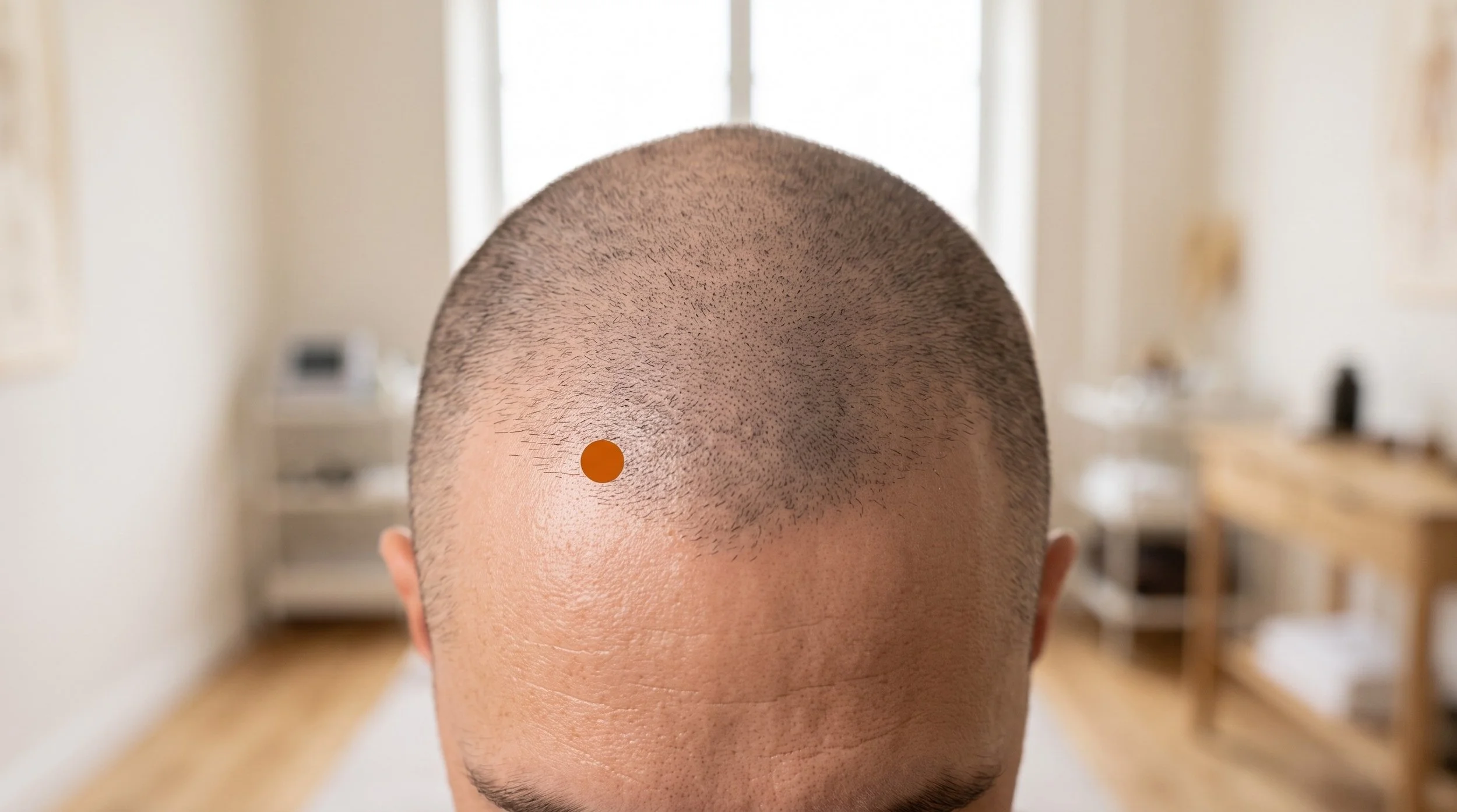 BL4 Acupuncture Point (Quchai)