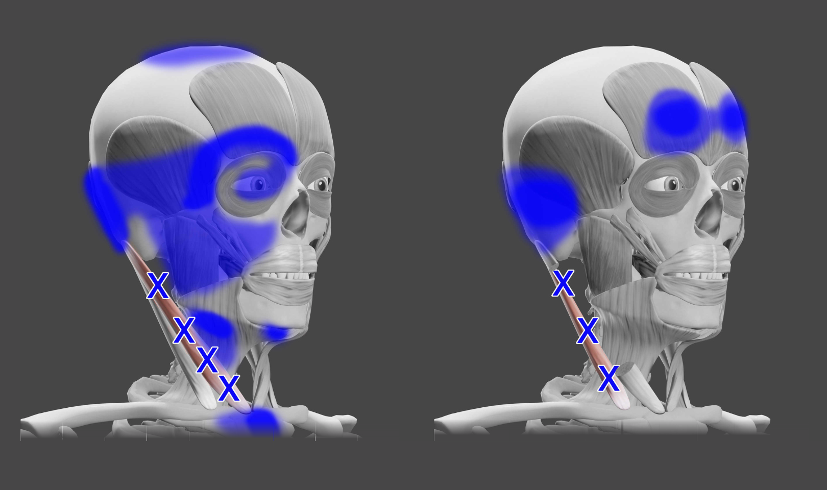Sternocleidomastoid (SCM) Trigger Points — Morningside Acupuncture NYC