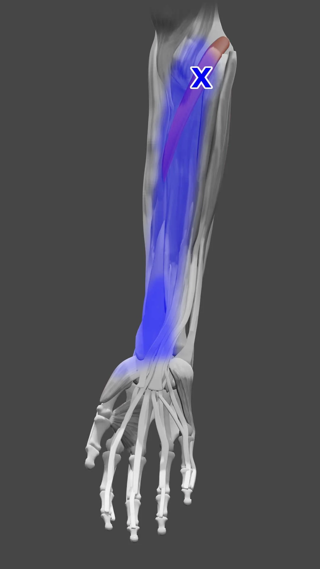 Pronator Teres trigger points