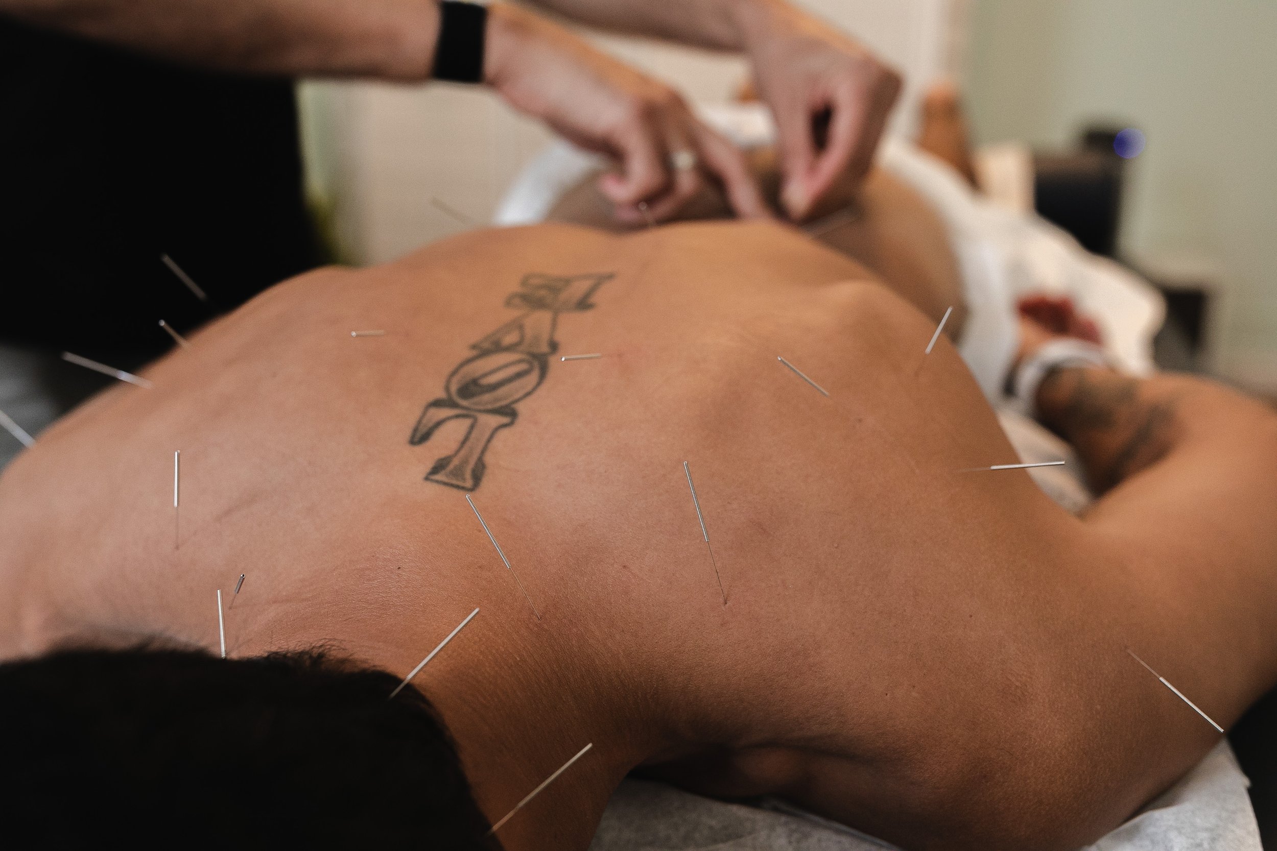Acupuncture for Sciatica — Morningside Acupuncture NYC