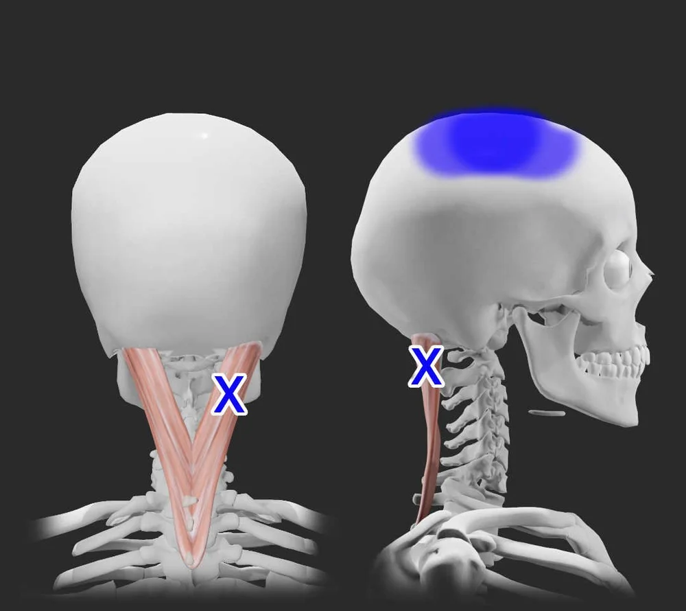 Splenius Capitis Trigger Points — Morningside Acupuncture NYC