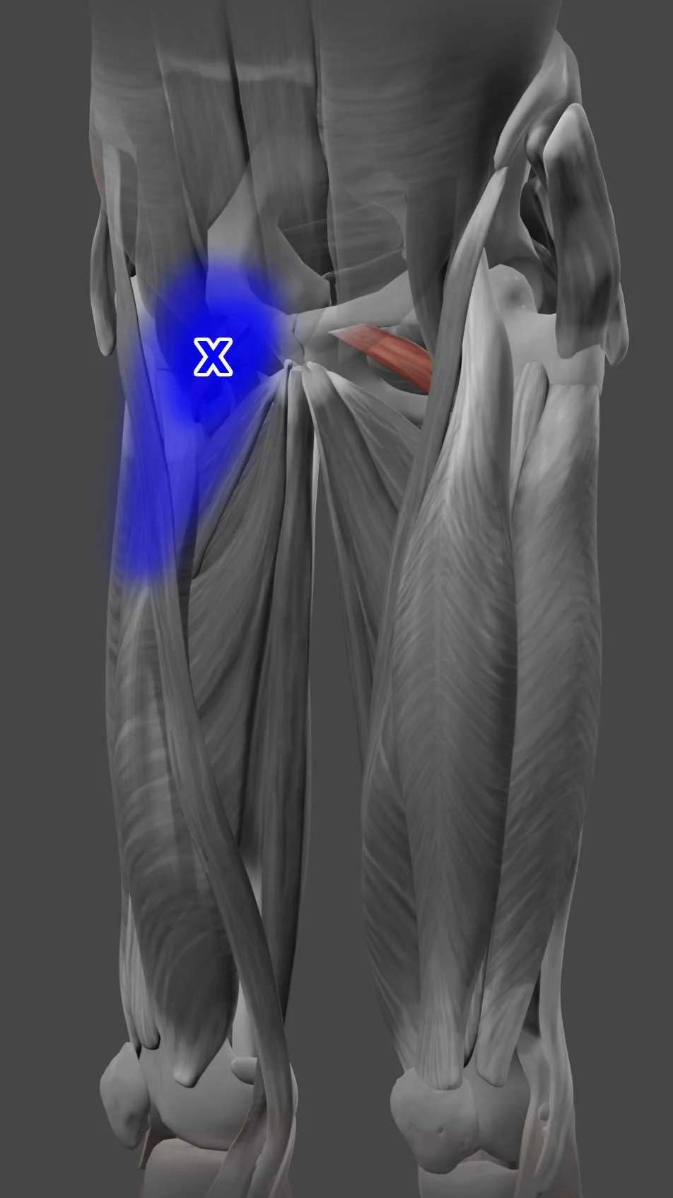 Pectineus trigger points