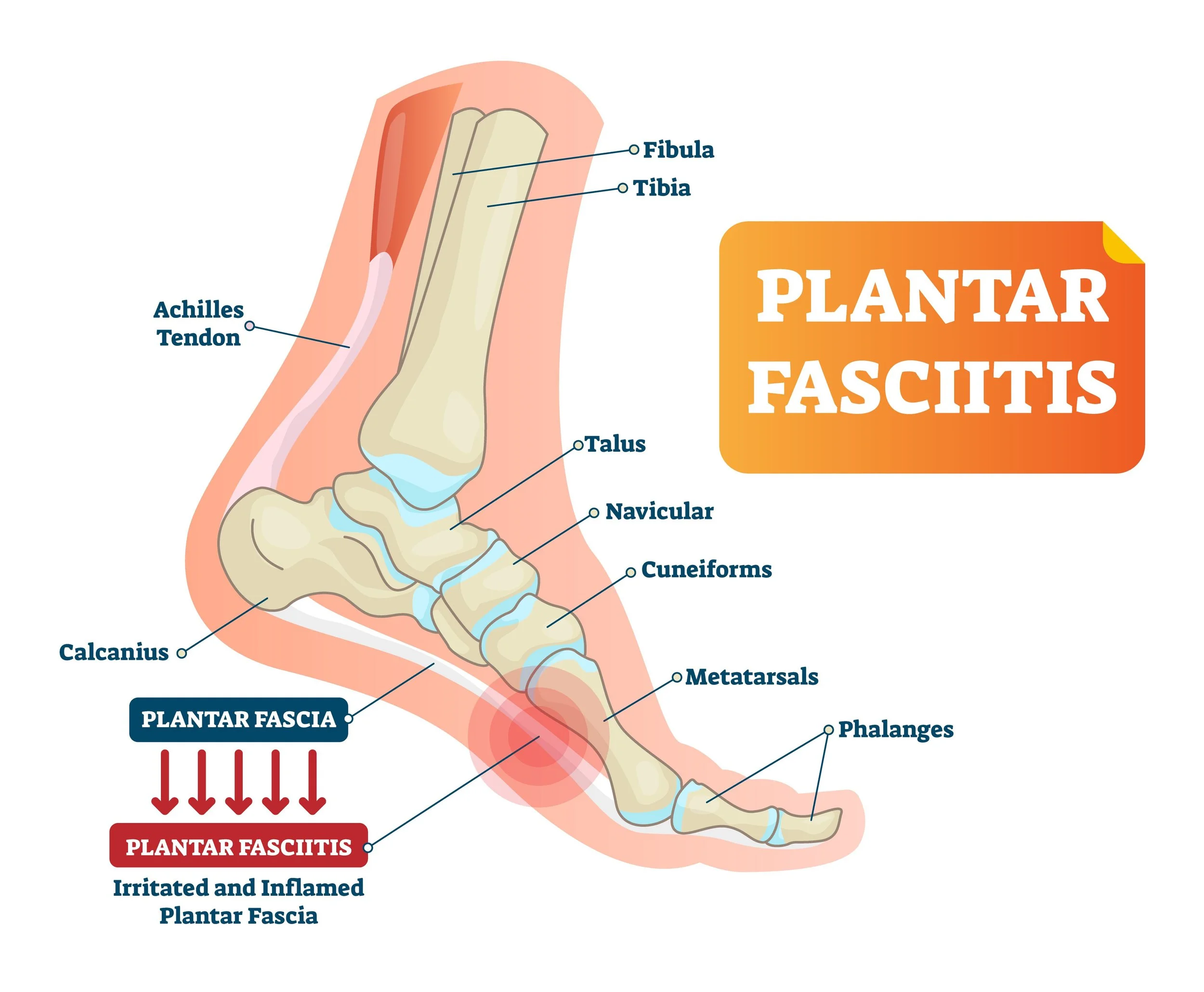 Surgical Heel Fasciitis Treatment Non Surgical Treatment For