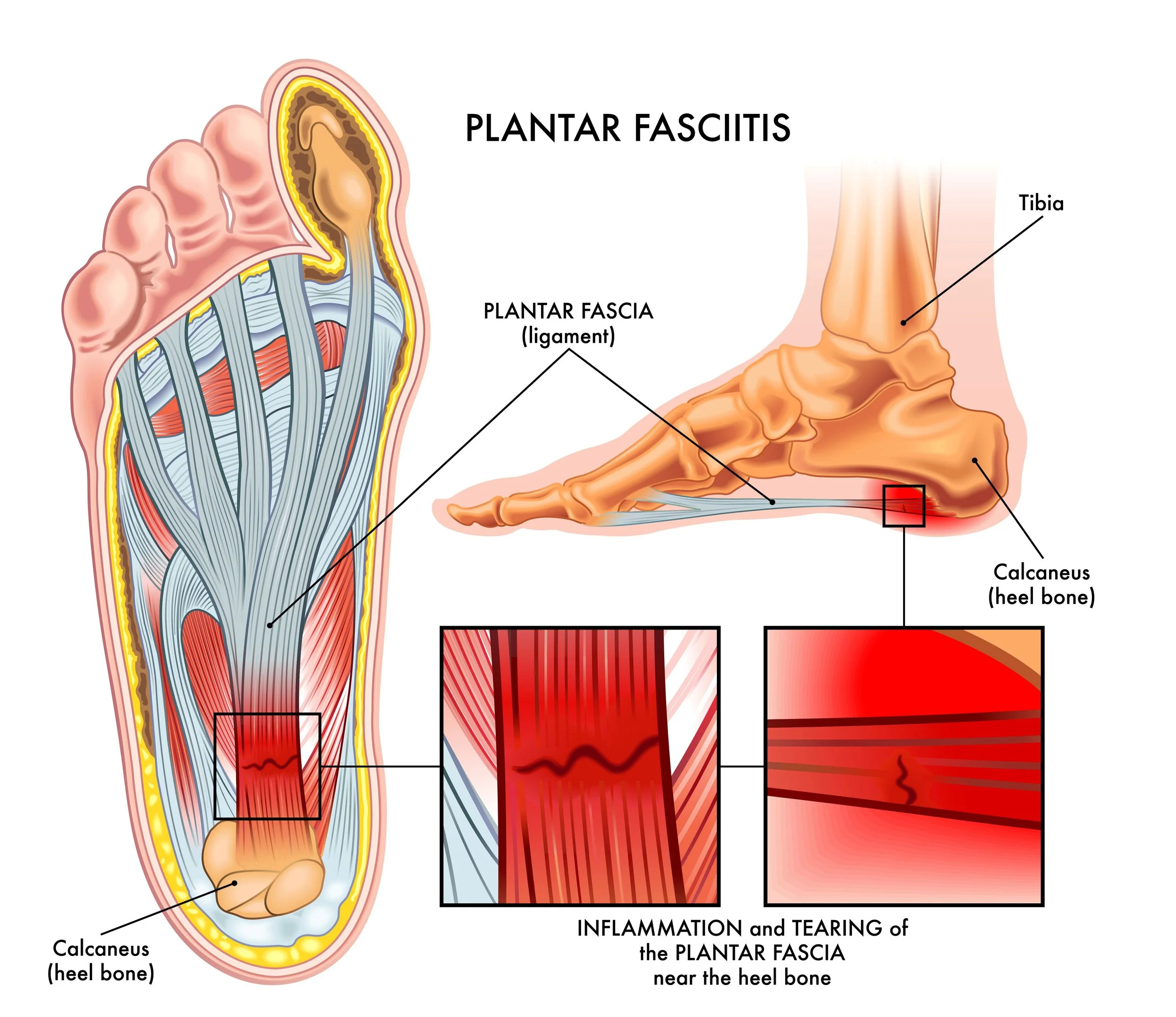 Calcaneus Top Of Heel Pain Plantar Fasciitis Achilles Tendon Pain