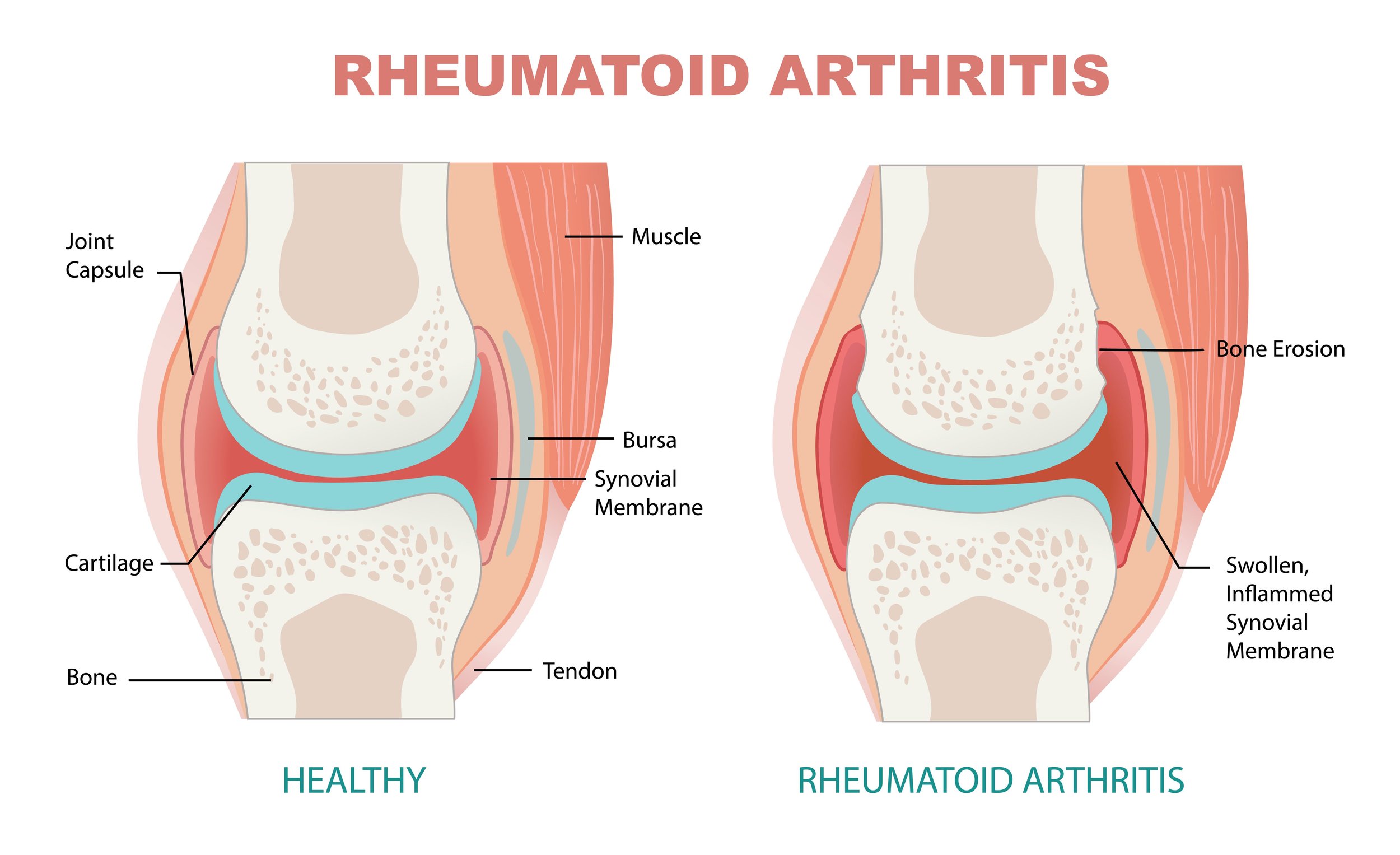 Acupuncture For Rheumatoid Arthritis Morningside Acupuncture NYC