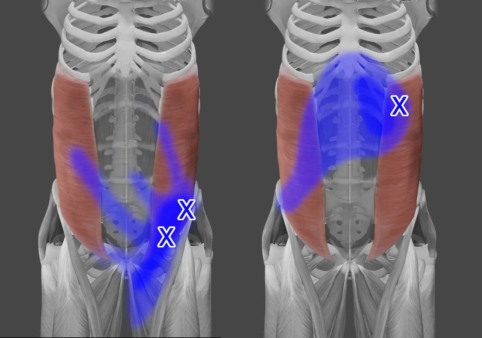 Abdominal Obliques trigger points