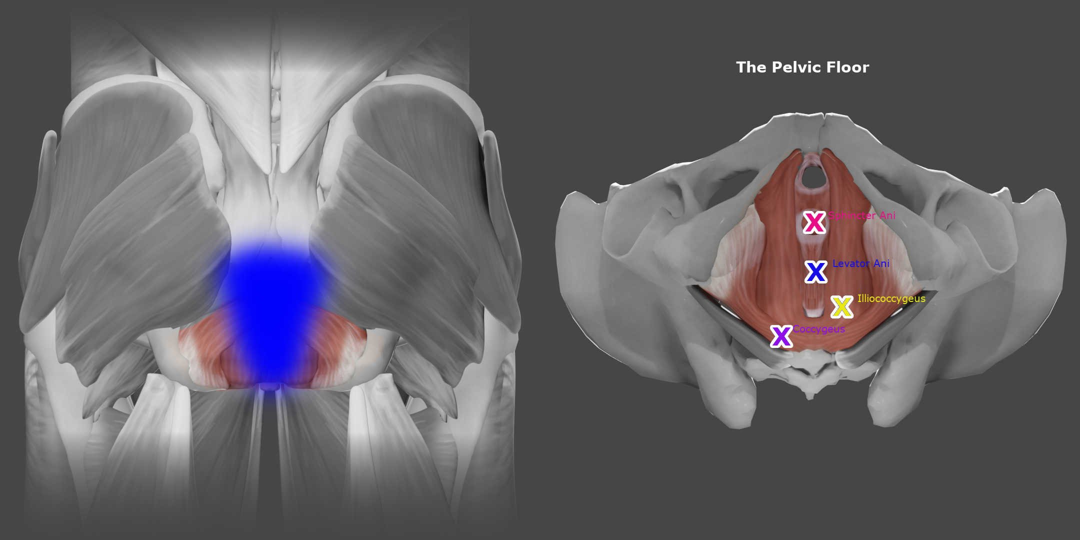 Levator Ani trigger points