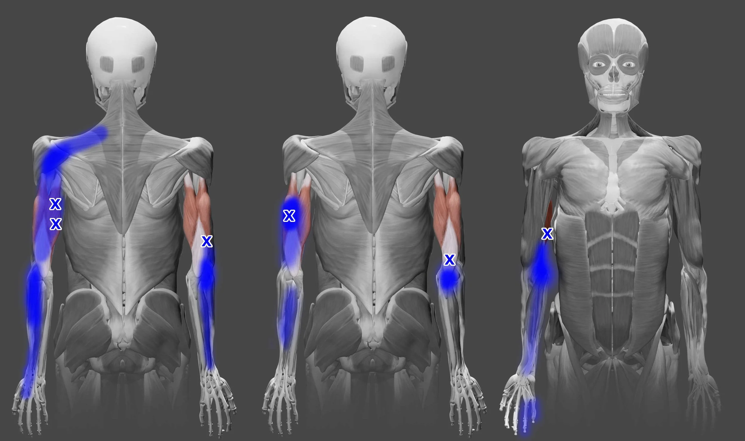 Triceps brachii trigger points