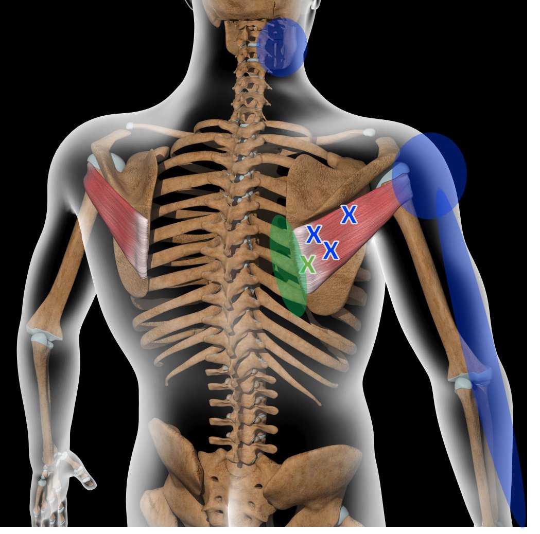 Acupuncture For Infraspinatus Trigger Points — Morningside Acupuncture Nyc