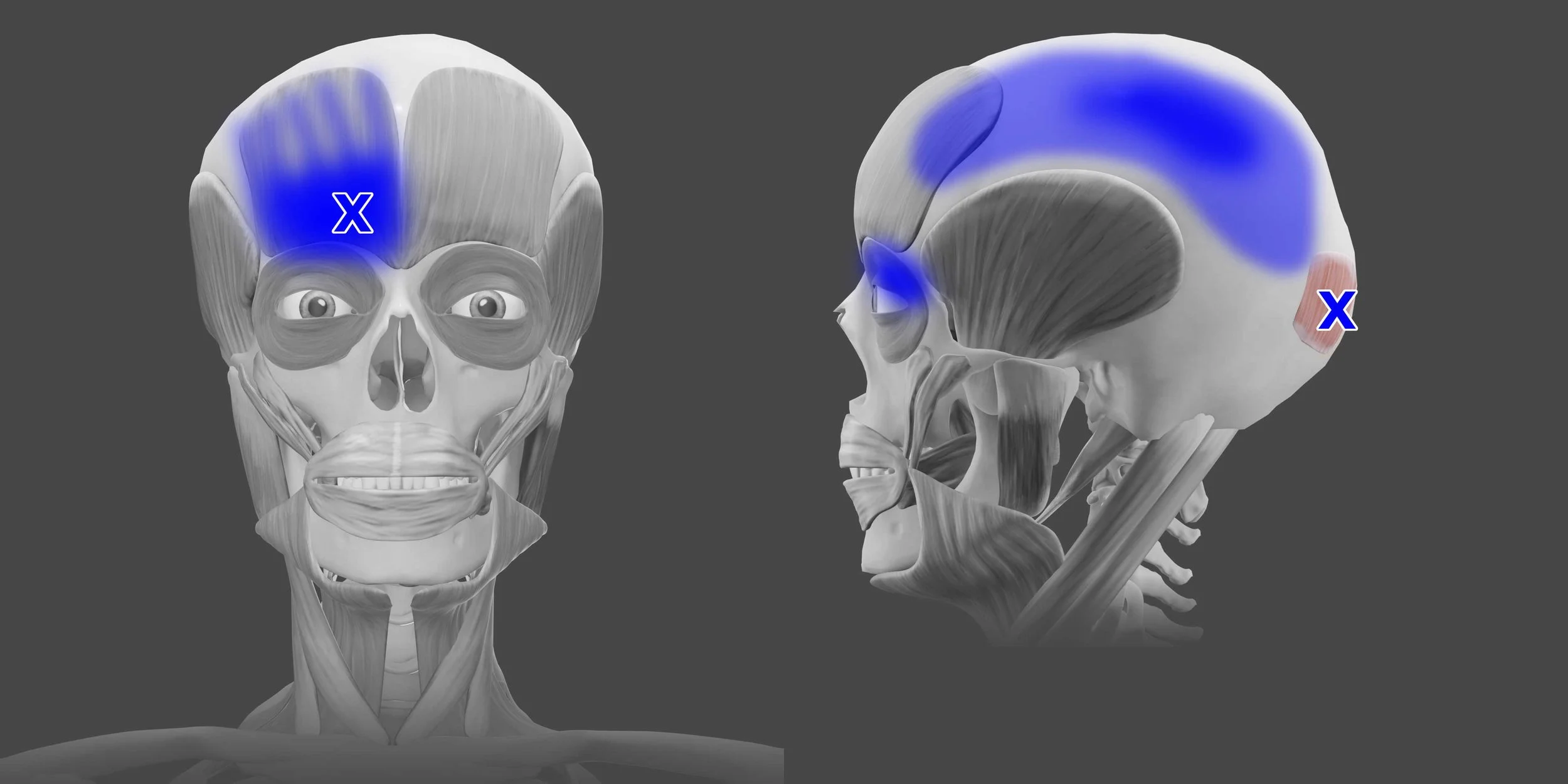 Occipitalis trigger points