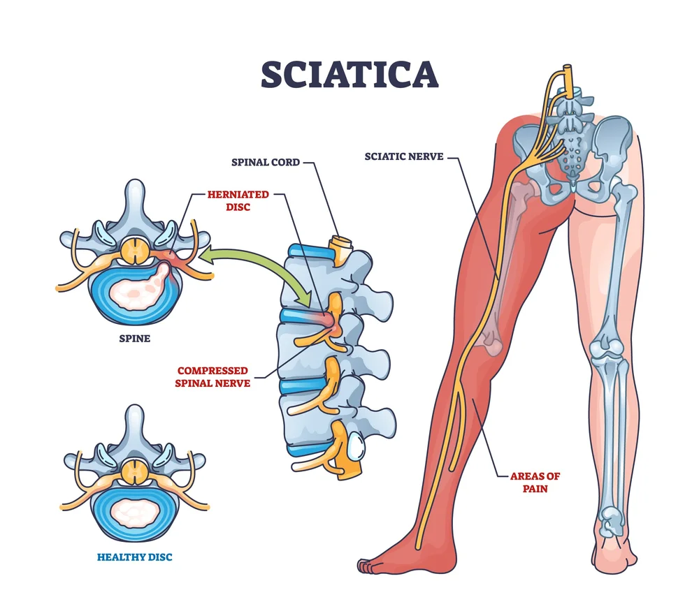 acupuncture-for-herniated-disc-sciatica-morningside-acupuncture-nyc