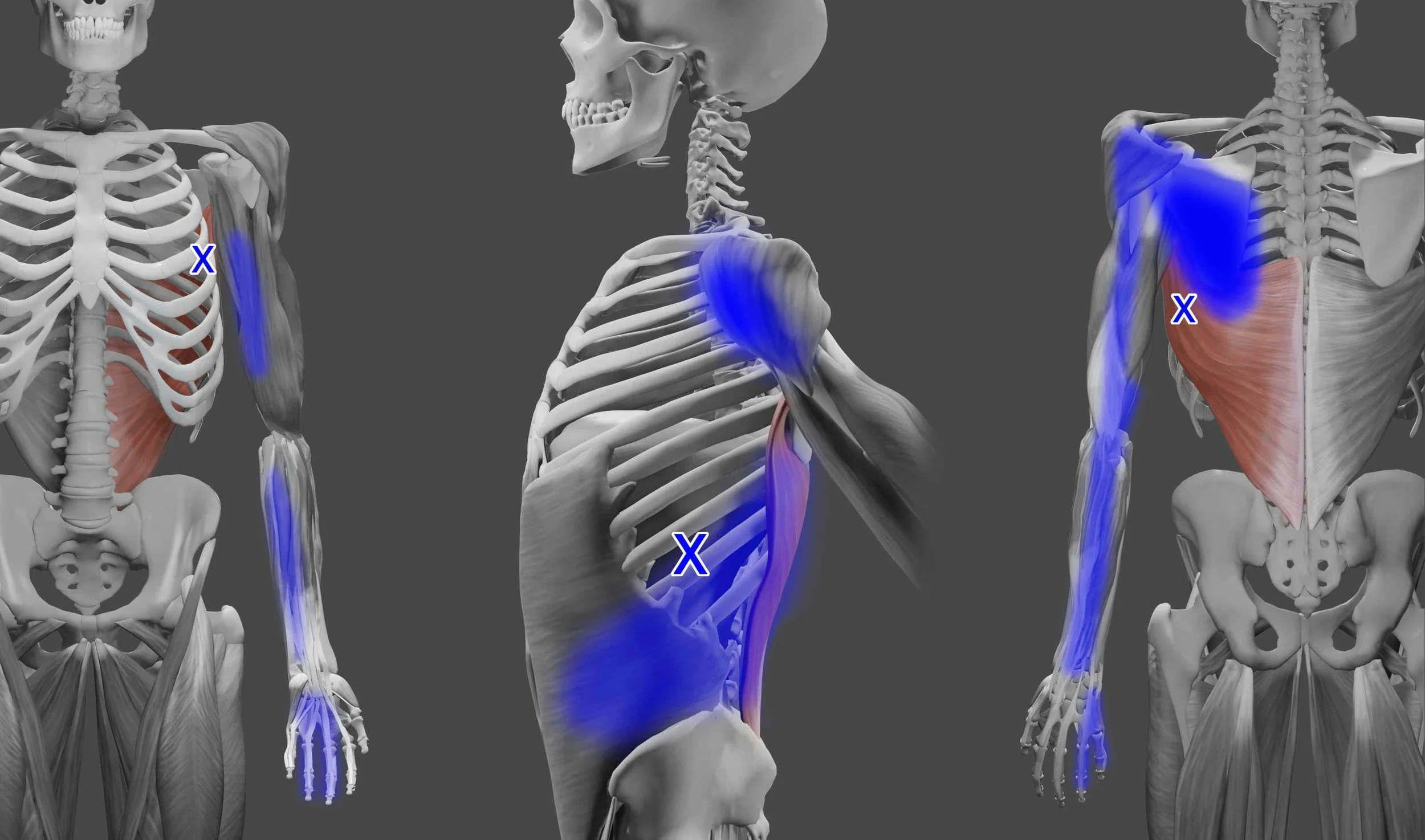 Latissimus dorsi trigger points