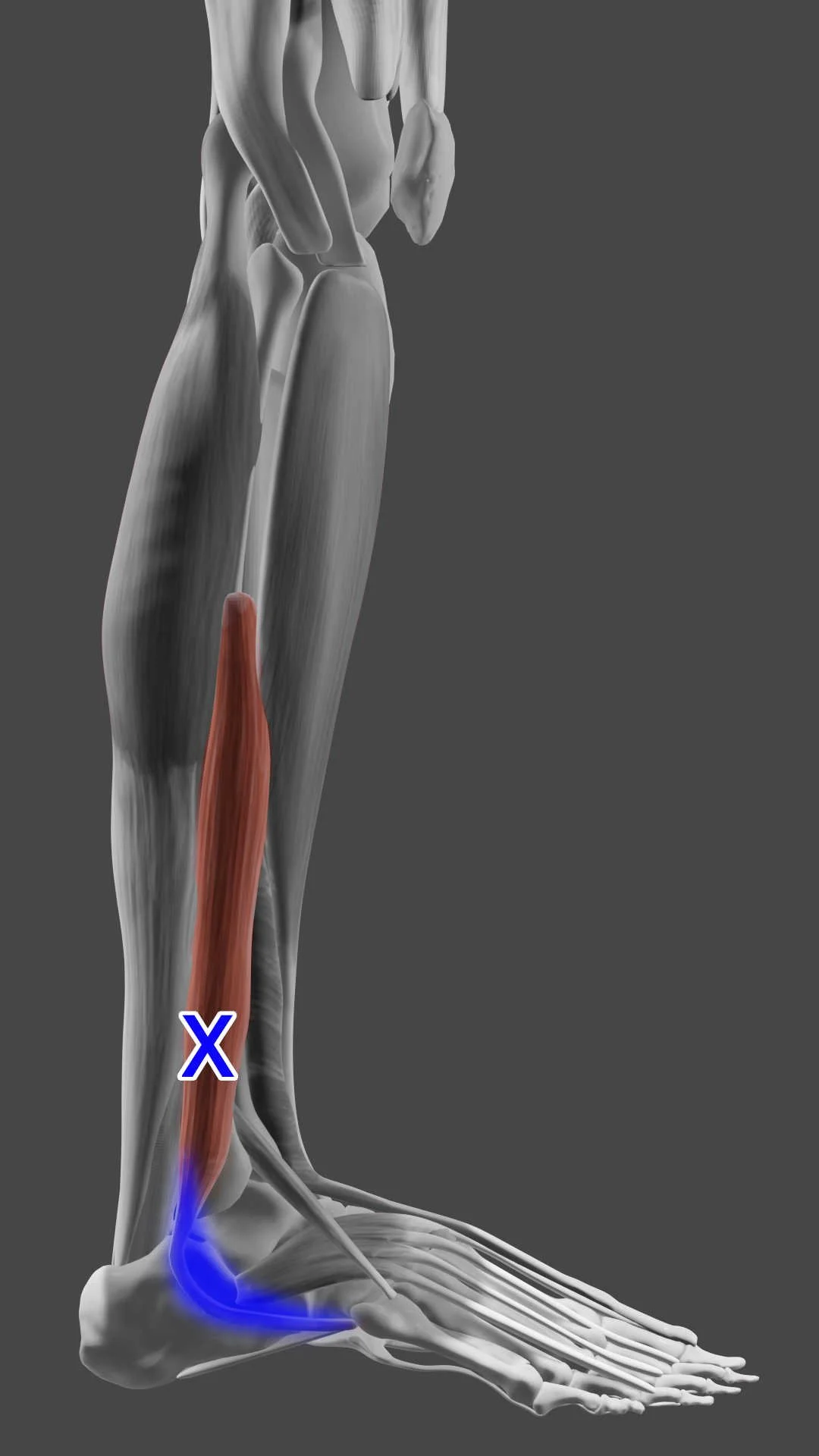 Peroneus Brevis trigger points
