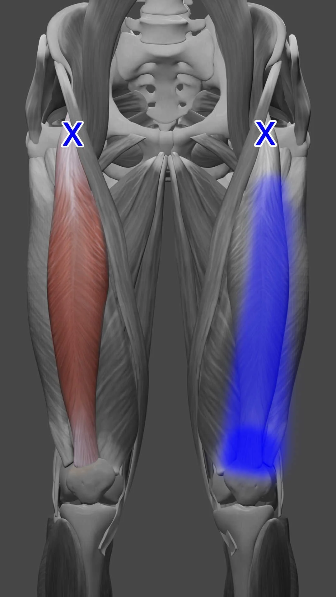 rectus femoris trigger points